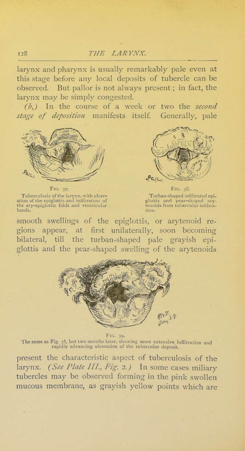 larynx and pharynx is usually remarkably pale even at this stage before any local deposits of tubercle can be observed. But pallor is not always present; in fact, the larynx may be simply congested. (b,) In the course of a week or two the second stage of deposition manifests itself. Generally, pale Fig. 37. Fig. 38. Tuberculosis of the larynx, with ulcer- Turban-shaped infiltrated epi- ation of the epiglottis and infiltration of glottis and pear-shaped ary- the ary-epiglottic folds and ventricular tenoids from tubercular inldua- bands. tion. smooth swellings of the epiglottis, or arytenoid re- gions appear, at first unilaterally, soon becoming bilateral, till the turban-shaped pale grayish epi- glottis and the pear-shaped swelling of the arytenoids Fig. 39. The same as Fig. 38, but two months later, showing more extensive infiltration and rapidly advancing ulceration of the tubercular deposit. present the characteristic aspect of tuberculosis of the larynx. (See Plate III., Fig. 2.) In some cases miliary tubercles may be observed forming in the pink swollen mucous membrane, as grayish yellow points which are