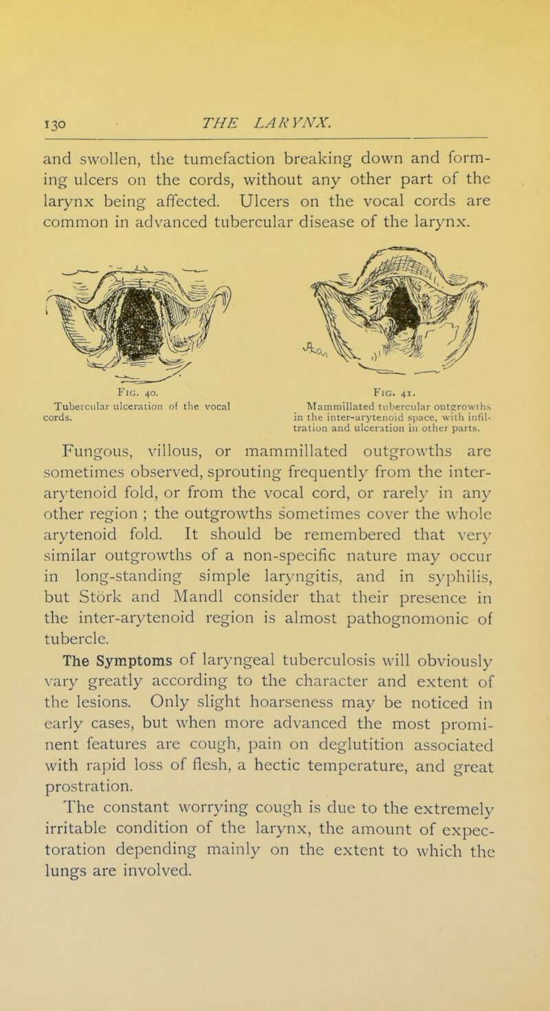 and swollen, the tumefaction breaking down and form- ing ulcers on the cords, without any other part of the larynx being affected. Ulcers on the vocal cords are common in advanced tubercular disease of the larynx. Fungous, villous, or mammillated outgrowths are sometimes observed, sprouting frequently from the inter- arytenoid fold, or from the vocal cord, or rarely in any other region ; the outgrowths sometimes cover the whole arytenoid fold. It should be remembered that very similar outgrowths of a non-specific nature may occur in long-standing simple laryngitis, and in syphilis, but Stork and Mandl consider that their presence in the inter-arytenoid region is almost pathognomonic of tubercle. The Symptoms of laryngeal tuberculosis will obviously vary greatly according to the character and extent of the lesions. Only slight hoarseness may be noticed in early cases, but when more advanced the most promi- nent features are cough, pain on deglutition associated with rapid loss of flesh, a hectic temperature, and great prostration. The constant worrying cough is due to the extremely irritable condition of the larynx, the amount of expec- toration depending mainly on the extent to which the lungs are involved. Fig. 40. Tubercular ulceration of the vocal cords. Fig. 41. Mammillated tubercular outgrowths in the inter-arytenoid space, with infil- tration and ulceration in other parts.