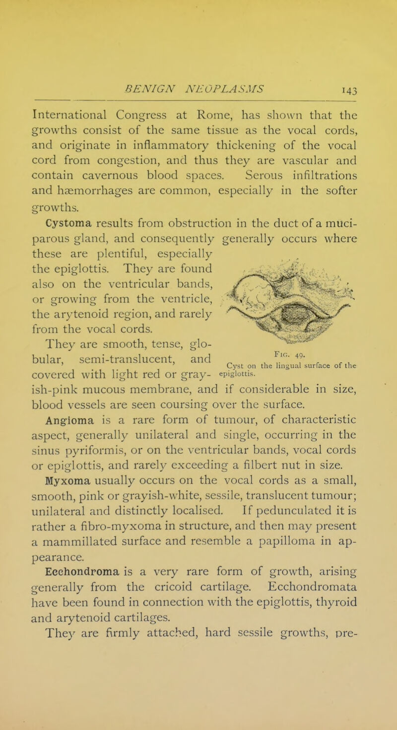 International Congress at Rome, has shown that the growths consist of the same tissue as the vocal cords, and originate in inflammatory thickening of the vocal cord from congestion, and thus they are vascular and contain cavernous blood spaces. Serous infiltrations and haemorrhages are common, especially in the softer growths. Cystoma results from obstruction in the duct of a muci- parous gland, and consequently generally occurs where these are plentiful, especially the epiglottis. They are found also on the ventricular bands, or growing from the ventricle, the arytenoid region, and rarely from the vocal cords. They are smooth, tense, glo- bular, semi-translucent, and covered with light red or gray- epiglottis, ish-pink mucous membrane, and if considerable in size, blood vessels are seen coursing over the surface. Angioma is a rare form of tumour, of characteristic aspect, generally unilateral and single, occurring in the sinus pyriformis, or on the ventricular bands, vocal cords or epiglottis, and rarely exceeding a filbert nut in size. Myxoma usually occurs on the vocal cords as a small, smooth, pink or grayish-white, sessile, translucent tumour; unilateral and distinctly localised. If pedunculated it is rather a fibro-myxoma in structure, and then may present a mammillated surface and resemble a papilloma in ap- pearance. Eeehondroma is a very rare form of growth, arising generally from the cricoid cartilage. Ecchondromata have been found in connection with the epiglottis, thyroid and arytenoid cartilages. They are firmly attached, hard sessile growths, pre- FlG. 49. Cyst on the lingual surface of the