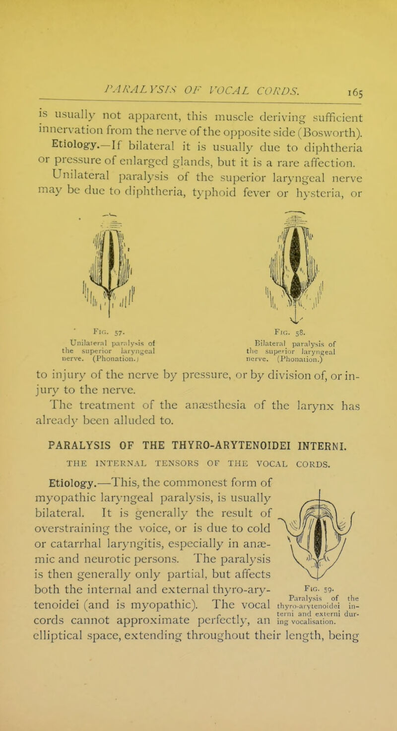 PARALYSIS OF VOCAL CORDS. is usually not apparent, this muscle deriving sufficient innervation from the nerve of the opposite side (Bosworth). Etiology.—If bilateral it is usually due to diphtheria or pressure of enlarged glands, but it is a rare affection. Unilateral paralysis of the superior laryngeal nerve may be due to diphtheria, typhoid fever or hysteria, or Fig. 57. Unil.neml paralysis of the superior laryngeal nerve. (Phonation.j Fi«. 58. Bilateral paralysis of the superior laryngeal nerve. (Phonaiion.) to injury of the nerve by pressure, or by division of, or in- jury to the nerve. The treatment of the anaesthesia of the larynx has already been alluded to. PARALYSIS OF THE THYRO-ARYTENOIDEI INTERNI. THE INTERNAL TENSORS OF THE VOCAL CORDS. Etiology.—This, the commonest form of myopathic laryngeal paralysis, is usually bilateral. It is generally the result of overstraining the voice, or is due to cold or catarrhal laryngitis, especially in anae- mic and neurotic persons. The paralysis is then generally only partial, but affects both the internal and external thyro-ary- Fir- 59- tenoidei (and is myopathic). The vocal thyro^aryunoidei \n- , • r 1 terni and extern! dur- cords cannot approximate perfectly, an ing vocalisation, elliptical space, extending throughout their length, being