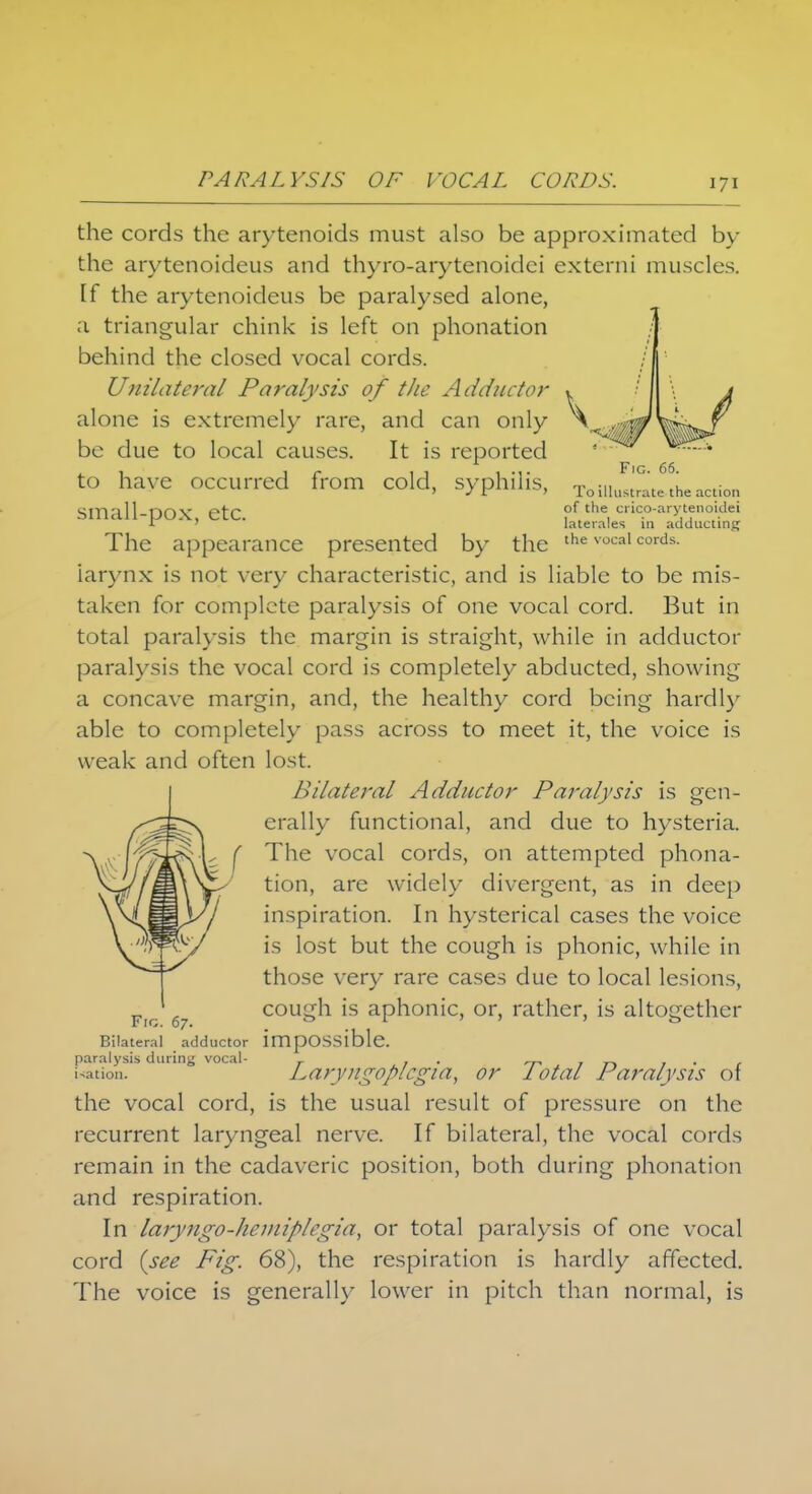 Fig. 66. To illustrate the action of the crico-arytenoidei Laterales in adductinj; the cords the arytenoids must also be approximated by the arytenoideus and thyro-arytenoidci externi muscles, [f the arytenoideus be paralysed alone, a triangular chink is left on phonation behind the closed vocal cords. Unilateral Paralysis of the Adductor alone is extremely rare, and can only be due to local causes. It is reported to have occurred from cold, syphilis, small-pox, etc. The appearance presented by the the vocal cords- iarynx is not very characteristic, and is liable to be mis- taken for complete paralysis of one vocal cord. But in total paralysis the margin is straight, while in adductor paralysis the vocal cord is completely abducted, showing a concave margin, and, the healthy cord being hardly able to completely pass across to meet it, the voice is weak and often lost. Bilateral Adductor Paralysis is gen- erally functional, and due to hysteria. The vocal cords, on attempted phona- tion, are widely divergent, as in deep inspiration. In hysterical cases the voice is lost but the cough is phonic, while in those very rare cases due to local lesions, cough is aphonic, or, rather, is altogether Fic. 67. . . Bilateral adductor impossible, paralysis during vocal- _ . Nation. Laryngoplcgia, or lotal Paralysis of the vocal cord, is the usual result of pressure on the recurrent laryngeal nerve. If bilateral, the vocal cords remain in the cadaveric position, both during phonation and respiration. In laryngo-hcmiplcgia, or total paralysis of one vocal cord (see Fig. 68), the respiration is hardly affected. The voice is generally lower in pitch than normal, is