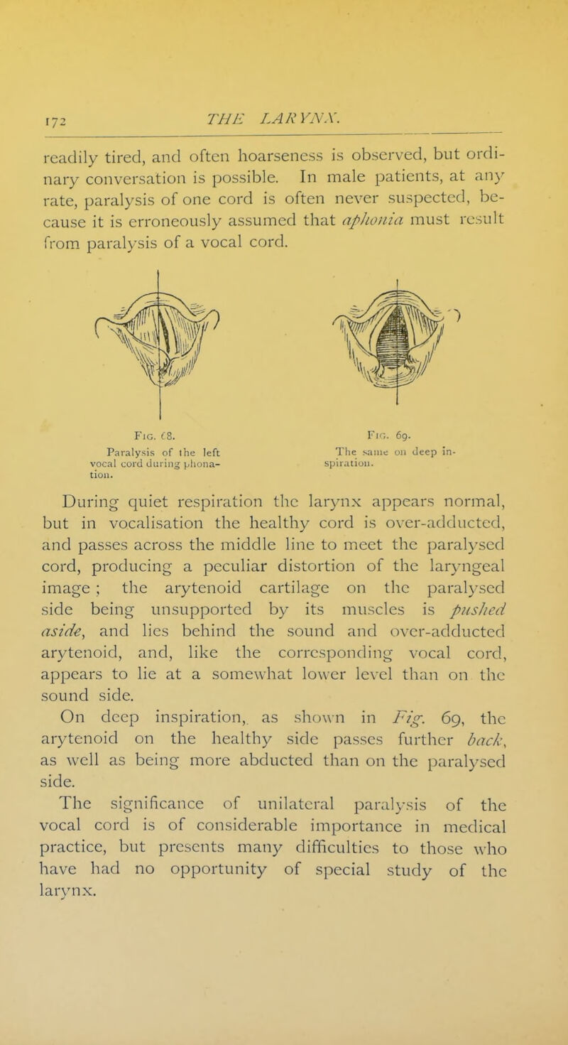 readily tired, and often hoarseness is observed, but ordi- nary conversation is possible. In male patients, at any rate, paralysis of one cord is often never suspected, be- cause it is erroneously assumed that aphonia must result from paralysis of a vocal cord. Fig. (8. Fio. 69. Paralysis of the left The same on deep in- vocal cord during phona- spiiaiiun. tion. During quiet respiration the larynx appears normal, but in vocalisation the healthy cord is ovcr-adducted, and passes across the middle line to meet the paralysed cord, producing a peculiar distortion of the laryngeal image ; the arytenoid cartilage on the paralysed side being unsupported by its muscles is pushed aside, and lies behind the sound and ovcr-adducted arytenoid, and, like the corresponding vocal cord, appears to lie at a somewhat lower level than on the sound side. On deep inspiration, as shown in Fig. 69, the arytenoid on the healthy side passes further back, as well as being more abducted than on the paralysed side. The significance of unilateral paralysis of the vocal cord is of considerable importance in medical practice, but presents many difficulties to those who have had no opportunity of special study of the larynx.