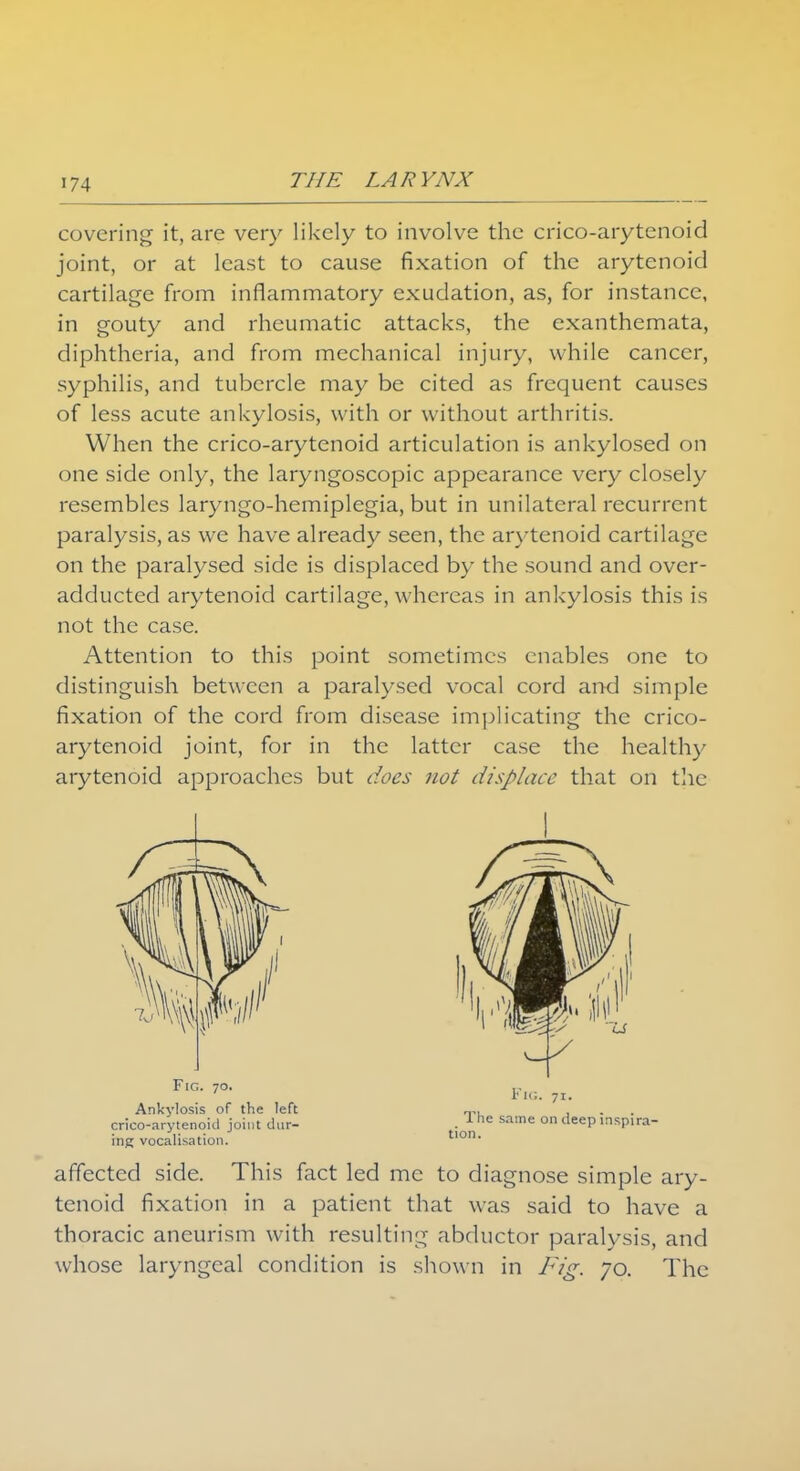 covering it, are very likely to involve the crico-arytenoid joint, or at least to cause fixation of the arytenoid cartilage from inflammatory exudation, as, for instance, in gouty and rheumatic attacks, the exanthemata, diphtheria, and from mechanical injury, while cancer, syphilis, and tubercle may be cited as frequent causes of less acute ankylosis, with or without arthritis. When the crico-arytenoid articulation is ankylosed on one side only, the laryngoscopic appearance very closely resembles laryngo-hemiplegia, but in unilateral recurrent paralysis, as we have already seen, the arytenoid cartilage on the paralysed side is displaced by the sound and over- adducted arytenoid cartilage, whereas in ankylosis this is not the case. Attention to this point sometimes enables one to distinguish between a paralysed vocal cord and simple fixation of the cord from disease implicating the crico- arytenoid joint, for in the latter case the healthy arytenoid approaches but does not displace that on the Fig. 70. Ankylosis of the left crico-arytenoid joint dur- ing vocalisation. Fig. 71. The same on deep inspira- tion. affected side. This fact led me to diagnose simple ary- tenoid fixation in a patient that was said to have a thoracic aneurism with resulting abductor paralysis, and whose laryngeal condition is shown in Fig. 70. The
