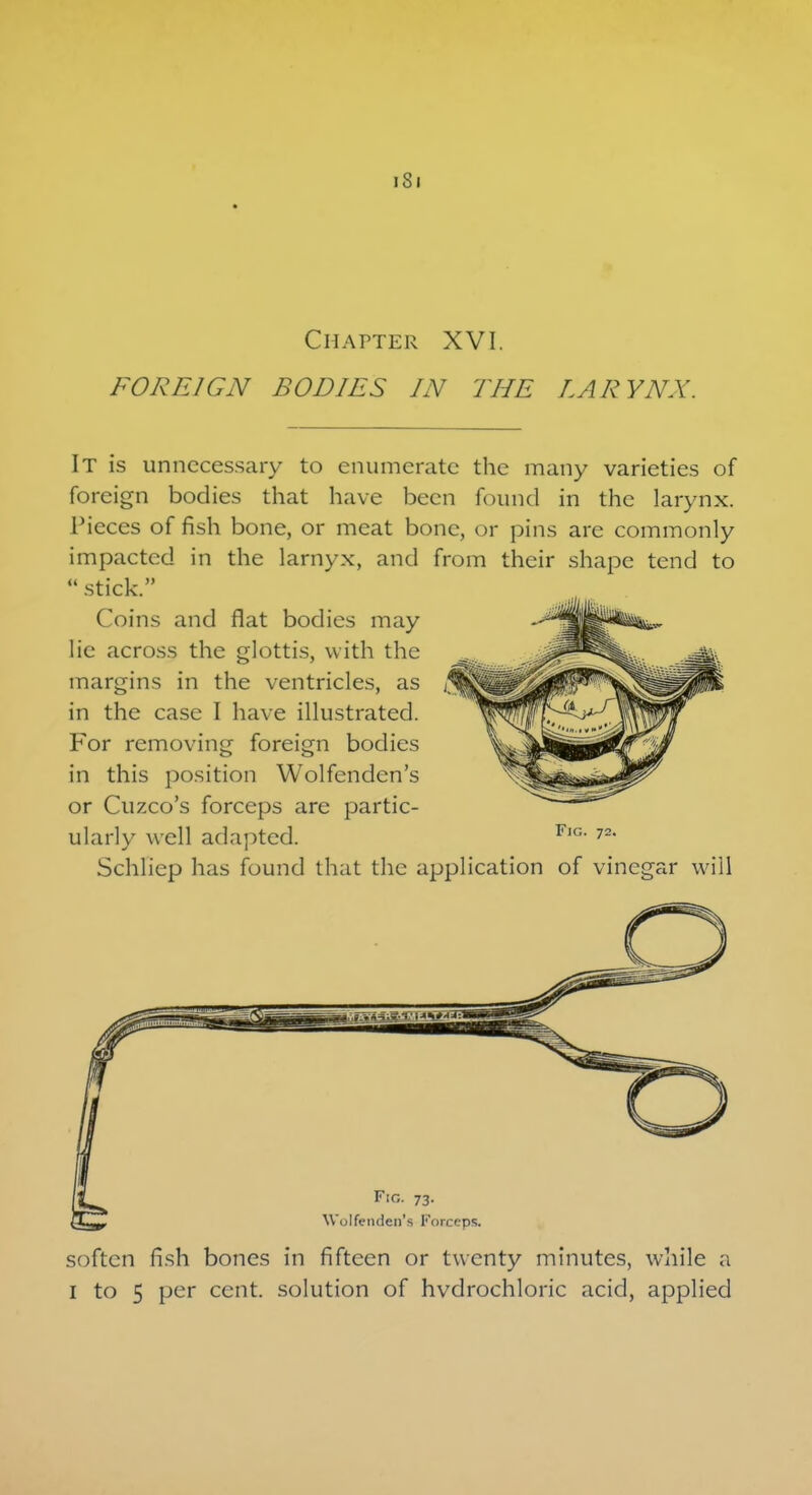 iSi Chapter XVI. FOREIGN BODIES IN THE LARYNX. It is unnecessary to enumerate the many varieties of foreign bodies that have been found in the larynx. Pieces of fish bone, or meat bone, or pins are commonly impacted in the lamyx, and from their shape tend to  stick. Coins and flat bodies may lie across the glottis, with the margins in the ventricles, as in the case I have illustrated. For removing foreign bodies in this position Wolfenden's or Cuzco's forceps are partic- ularly well adapted. F,c- 72- Schfiep has found that the application of vinegar will Fig. 73. Wolfenden'fl Forceps. soften fish bones in fifteen or twenty minutes, while a 1 to 5 per cent, solution of hvdrochloric acid, applied