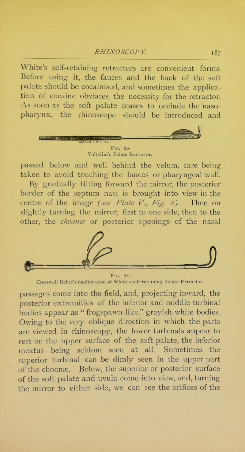 White's self-retaining retractors are convenient forms. Before using it, the fauces and the back of the soft palate should be cocainised, and sometimes the applica- tion of cocaine obviates the necessity for the retractor. As soon as the soft palate ceases to occlude the naso- pharynx, the rhinoscope should be introduced and Fu;. 80. Voltolini's Palate Retractor. passed below and well behind the velum, care being taken to avoid touching the fauces or pharyngeal wall. By gradually tilting forward the mirror, the posterior border of the septum nasi is brought into view in the centre of the image (see Plate V., Fig. 2). Then on slightly turning the mirror, first to one side, then to the other, the choance or posterior openings of the nasal Fig. 81. Cresswell Baber's modification of White's self-retaining Palate Retractor. passages come into the field, and, projecting inward, the posterior extremities of the inferior and middle turbinal bodies appear as  frogspawn-like, grayish-white bodies. Owing to the very oblique direction in which the parts are viewed in rhinoscopy, the lower turbinals appear to rest on the upper surface of the soft palate, the inferior meatus being seldom seen at all. Sometimes the superior turbinal can be dimly seen in the upper part of the choanse. Below, the superior or posterior surface of the soft palate and uvula come into view, and, turning the mirror to either side, we can see the orifices of the