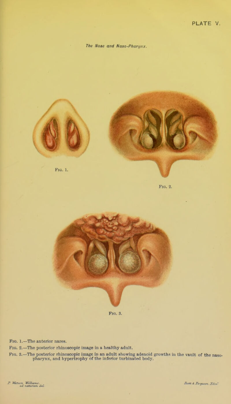 PLATE V. The Nose and Naso-Pharynx. V Fto. 3. Fio. 1.— The anterior riares. Pio. 2.—The posterior rhinoscopic image in a healthy adult. Fig. 3.—The posterior rhinoscopic image in an adult showing adenoid growths in the vault of the naso- pharynx, and hypertrophy of the inferior turbinated body. P mtscn Wilhams ad natarxm d*l Scott t. Feroustm. Xdmr