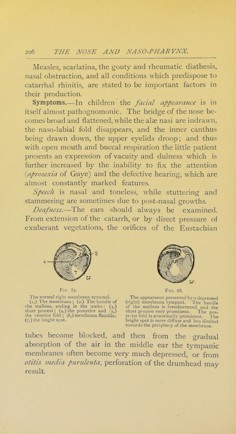 Measles, scarlatina, the gouty and rheumatic diathesis, nasal obstruction, and all conditions which predispose to catarrhal rhinitis, are stated to be important factors in their production. Symptoms—In children the facial appearance is in itself almost pathognomonic. The bridge of the nose be- comes broad and flattened, while the alae nasi are indrawn, the naso-labial fold disappears, and the inner canthus being drawn down, the upper eyelids droop; and thus with open mouth and buccal respiration the little patient presents an expression of vacuity and dulness which is further increased by the inability to fix the attention {aprosexia of Guye) and the defective hearing, which are almost constantly marked features. Speech is nasal and toneless, while stuttering and stammering are sometimes due to post-nasal growths. Deafness.—The ears should always be examined. From extension of the catarrh, or by direct pressure of exuberant vegetations, the orifices of the Eustachian Fig. 87. The normal right membrana tympani. (1,) The membrana; (2,) The handle of the malleus, ending in the umbo; (3,) short process; (4,) the posterior and (5,) the nnterior fold ; (6,) membrana flaccida; (7,) the bright spot. Fig. 88. The appearance presented by a depressed (right) membrana tympani. 'The handle of the malleus is ioreshortened and the short process very prominent. The pos- te'ior fold is abnormally prominent. The bright spot is more diffuse and less distinct towards the periphery of the membrane. tubes become blocked, and then from the gradual absorption of the air in the middle ear the tympanic membranes often become very much depressed, or from otitis media purulenta, perforation of the drumhead may result.