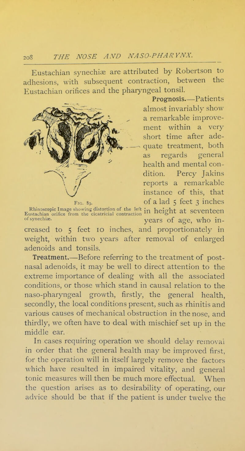 Eustachian synechiae are attributed by Robertson to adhesions, with subsequent contraction, between the Eustachian orifices and the pharyngeal tonsil. Prognosis—Patients almost invariably show a remarkable improve- ment within a very short time after ade- - quate treatment, both as regards general health and mental con- dition. Percy Jakins reports a remarkable instance of this, that fig. s9. of a lad 5 feet 3 inches Rhinoscopic Image showing distortion of the left ;,, V>/=>irrVif of covpnfppn Eustachian orifice from the cicatricial contraction 111 nelgnt dt Seventeen ofsynechiae. years of age, who in- creased to 5 feet 10 inches, and proportionately in weight, within two years after removal of enlarged adenoids and tonsils. Treatment.—Before referring to the treatment of post- nasal adenoids, it may be well to direct attention to the extreme importance of dealing with all the associated conditions, or those which stand in causal relation to the naso-pharyngeal growth, firstly, the general health, secondly, the local conditions present, such as rhinitis and various causes of mechanical obstruction in the nose, and thirdly, we often have to deal with mischief set up in the middle ear. In cases requiring operation we should delay removal in order that the general health may be improved first, for the operation will in itself largely remove the factors which have resulted in impaired vitality, and general tonic measures will then be much more effectual. When the question arises as to desirability of operating, our advice should be that if the patient is under twelve the