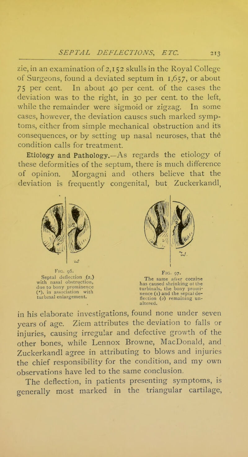 zic,in an examination of 2,152 skulls in the Royal College of Surgeons, found a deviated septum in 1,657, or about 75 per cent. In about 40 per cent, of the cases the deviation was to the right, in 30 per cent, to the left, while the remainder were sigmoid or zigzag. In some cases, however, the deviation causes such marked symp- toms, cither from simple mechanical obstruction and it's consequences, or by setting up nasal neuroses, that the condition calls for treatment. Etiolog-y and Pathology.—As regards the etiology of these deformities of the septum, there is much difference of opinion. Morgagni and others believe that the deviation is frequently congenital, but Zuckerkandl, Fig. q5. Septal deflection (2,) with nasal obstruction, line to bony prominence (•)• in association with turbinal enlargement. i Fig. 07. The same alter cocaine has caused shrinking ot the turbinals, the bony promi- nence (1) and the septal de- flection (2) remaining un- altered. in his elaborate investigations, found none under seven years of age. Zicm attributes the deviation to falls or injuries, causing irregular and defective growth of the other bones, while Lennox Browne, MacDonald, and Zuckerkandl agree in attributing to blows and injuries the chief responsibility for the condition, and my own observations have led to the same conclusion. The deflection, in patients presenting symptoms, is generally most marked in the triangular cartilage,