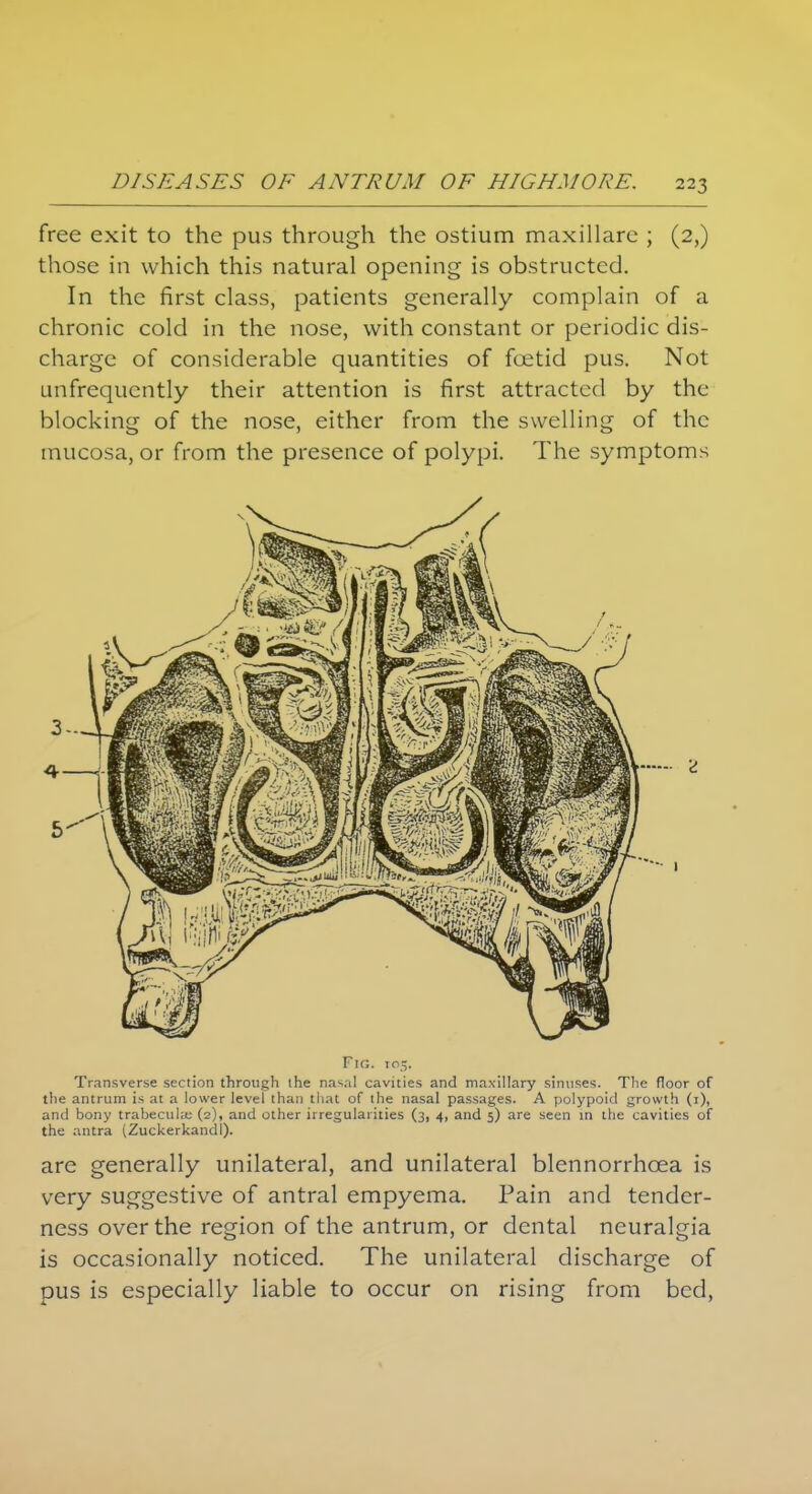 free exit to the pus through the ostium maxillare ; (2,) those in which this natural opening is obstructed. In the first class, patients generally complain of a chronic cold in the nose, with constant or periodic dis- charge of considerable quantities of foetid pus. Not Linfrequcntly their attention is first attracted by the blocking of the nose, either from the swelling of the mucosa, or from the presence of polypi. The symptoms 2 Fig. 105. Transverse section through the nasal cavities and maxillary sinuses. The floor of the antrum is at a lower level than tliat of the nasal passages. A polypoid growth (i), and bony trabecule (2), and other irregularities (3, 4, and 5) are seen in the cavities of the antra (Zuckerkandl). are generally unilateral, and unilateral blennorrhcea is very suggestive of antral empyema. Pain and tender- ness over the region of the antrum, or dental neuralgia is occasionally noticed. The unilateral discharge of pus is especially liable to occur on rising from bed,