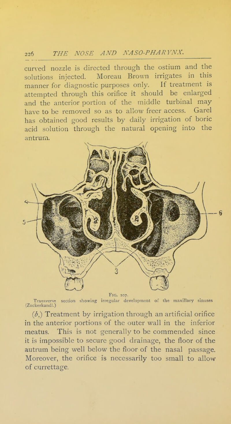 curved nozzle is directed through the ostium and the solutions injected. Moreau Brown irrigates in this manner for diagnostic purposes only. If treatment is attempted through this orifice it should be enlarged and the anterior portion of the middle turbinal may- have to be removed so as to allow freer access. Garel has obtained good results by daily irrigation of boric acid solution through the natural opening into the antrum. Fig. 107. Transverse section showing irregular development of the maxillary sinuses (Zuckerkandl.) (b,) Treatment by irrigation through an artificial orifice in the anterior portions of the outer wall in the inferior meatus. This is not generally to be commended since it is impossible to secure good drainage, the floor of the autrum being well below the floor of the nasal passage. Moreover, the orifice is necessarily too small to allow of currettagC: