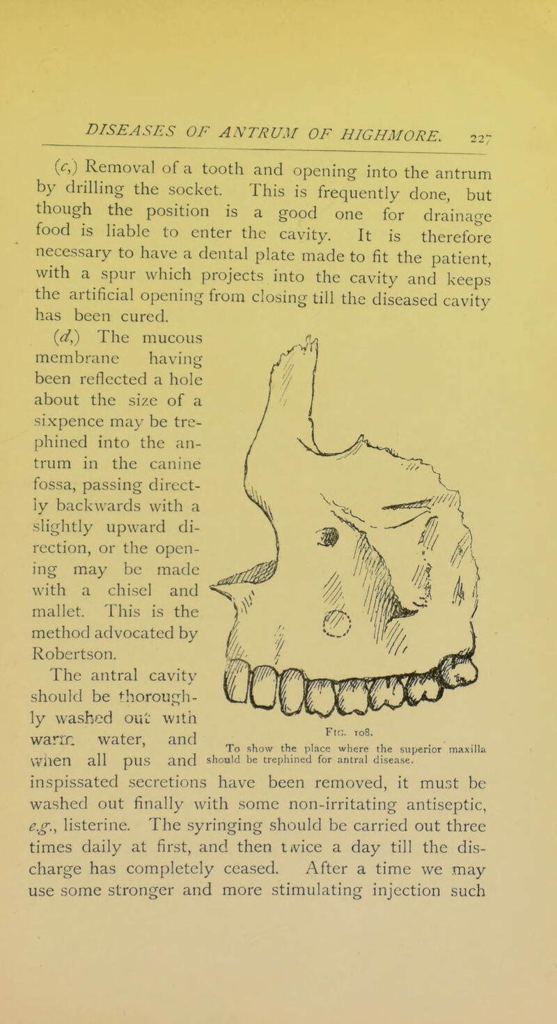 (c,) Removal of a tooth and opening into the antrum by drilling the socket. This is frequently done, but though the position is a good one for drainage food is liable to enter the cavity. It is therefore necessary to have a dental plate made to fit the patient, with a spur which projects into the cavity and keeps the artificial opening from closing till the diseased cavity has been cured. {d,) The mucous membrane having been reflected a hole about the size of a sixpence may be tre- phined into the an- trum in the canine fossa, passing direct- ly backwards with a slightly upward di- rection, or the open- ing may be made with a chisel and mallet. This is the method advocated by Robertson. The antral cavity should be ^horoucrh- ly washed out with warrr. water, and when all pus and inspissated secretions have been removed, it must be washed out finally with some non-irritating antiseptic, e.g., listerine. The syringing should be carried out three times daily at first, and then nvice a day till the dis- charge has completely ceased. After a time we may use some stronger and more stimulating injection such Fig. 108. To show the place where the superior maxilla should be trephined for antral disease.