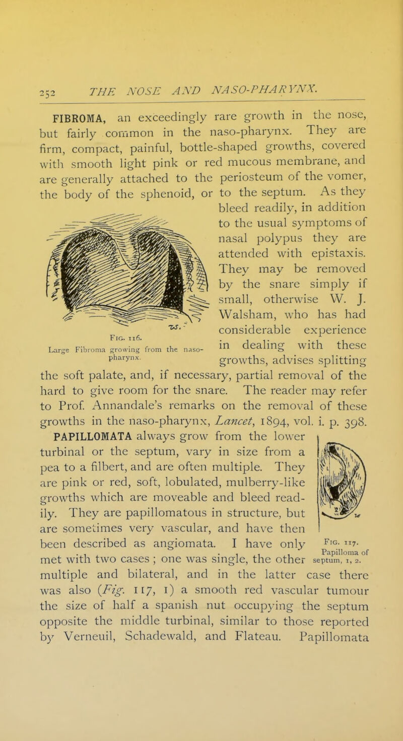 FIBROMA, an exceedingly rare growth in the nose, but fairly common in the naso-pharynx. They are firm, compact, painful, bottle-shaped growths, covered with smooth light pink or red mucous membrane, and are generally attached to the periosteum of the vomer, the body of the sphenoid, or to the septum. As they bleed readily, in addition to the usual symptoms of nasal polypus they are attended with epistaxis. They may be removed by the snare simply if small, otherwise W. J. Walsham, who has had considerable experience Large Fibroma mowing from the n,so- in dealing With theSC pharynx growths, advises splitting the soft palate, and, if necessary, partial removal of the hard to give room for the snare. The reader may refer to Prof. Annandale's remarks on the removal of these growths in the naso-pharynx, Lancet, 1894, vol. i. p. 398. PAPILLOMATA always grow from the lower turbinal or the septum, vary in size from a pea to a filbert, and are often multiple. They are pink or red, soft, lobulated, mulberry-like growths which are moveable and bleed read- ily. They are papillomatous in structure, but are sometimes very vascular, and have then been described as angiomata. I have only F,G- 7- . . • 1 1 1 Papilloma of met with two cases ; one was single, the other septum, i, 2. multiple and bilateral, and in the latter case there was also {Fig. 117, 1) a smooth red vascular tumour the size of half a Spanish nut occupying the septum opposite the middle turbinal, similar to those reported by Verneuil, Schadewald, and Flateau. Papillomata