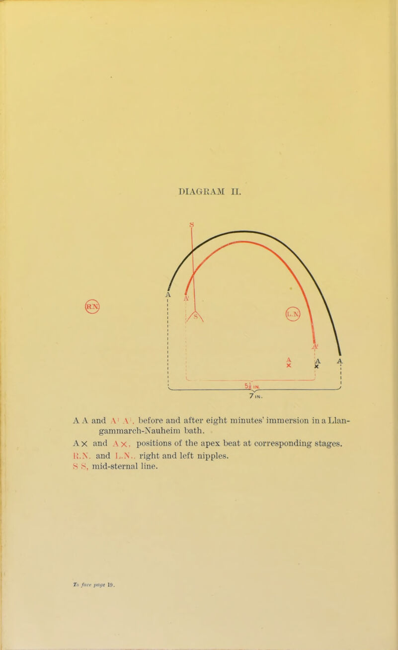 DIAGRAM II. 7 IN . A A and \ \ . before and after eight minutes' immersion in aLlan- gammarch-Nauheim bath. A x and A x. positions of the apex beat at corresponding stages. R.N. and l,.N.. right and left nipples. S >. mid-sternal line. To flier fmijt 1!).