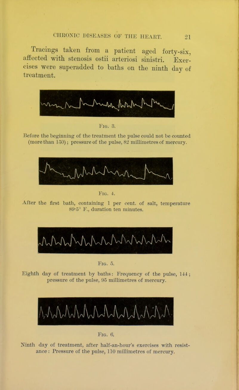Tracings taken from a patient aged forty-six, affected with stenosis ostii arteriosi sinistri. Exer- cises were superadded to baths on the ninth day of treatment. Fig. 3. Before the beginning of the treatment the pulse could not be counted (more than 150); pressure of the pulse, 82 millimetres of mercury. Fig. 4. After the first bath, containing 1 per cent, of salt, temperature 89o° F., duration ten minutes. Fig. 5. Fighth day of treatment by baths: Frequency of the pulse, 144; pressure of the pulse, 9o millimetres of mercury. Fig. 6. Ninth day of treatment, after half-an-hour's exercises with resist- ance : Pressure of the pulse, 110 millimetres of mercury.