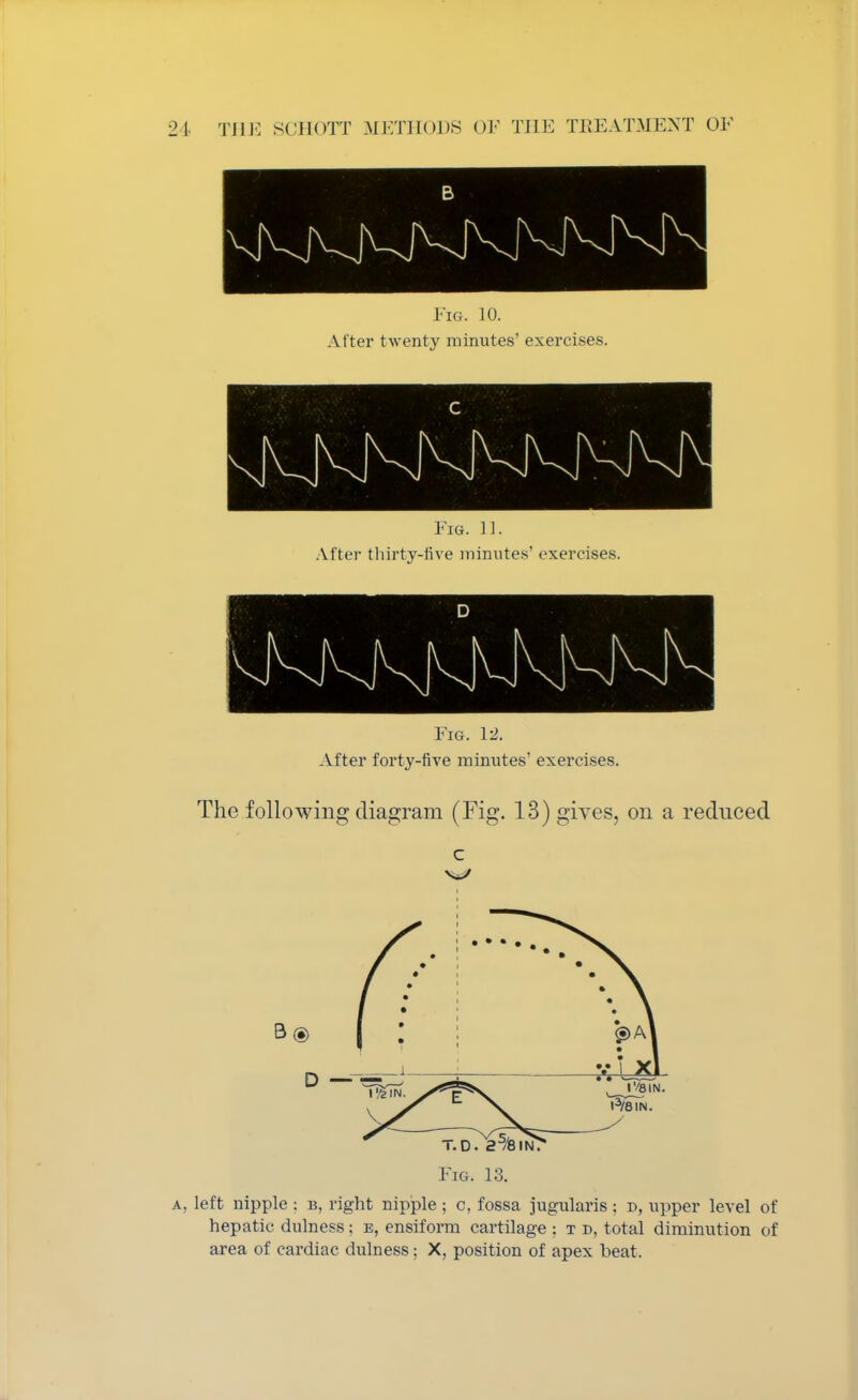Fig. 10. After twenty minutes' exercises. Fig. 11. Alter thirty-five minutes' exercises. BBS Fig. 12. After forty-five minutes' exercises. The following diagram (Fig. 13) gives, on a reduced 3 ® D — T.D. 25/8lN> Fig. 13. a, left nipple : b, right nipple ; c, fossa jugularis ; d, upper level of hepatic dulness; e, ensiform cartilage : t d, total diminution of area of cardiac dulness; X, position of apex beat.