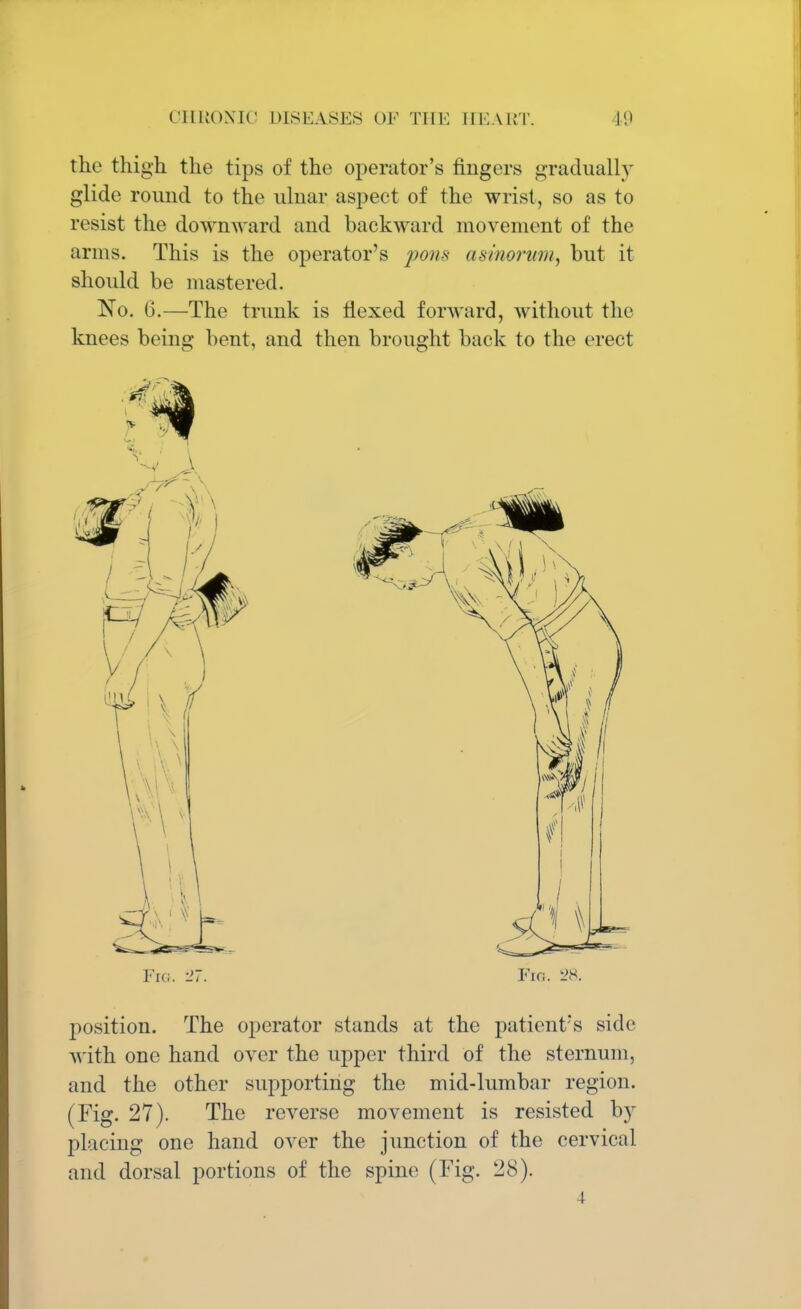 the thigh the tips of the operator's fingers gradually glide round to the ulnar aspect of the wrist, so as to resist the downward and backward movement of the arms. This is the operator's pons asinorum, but it should be mastered. No. 6.—The trunk is flexed forward, without the knees being bent, and then brought back to the erect Frc 27. Fig. l'S. position. The operator stands at the patient's side with one hand over the upper third of the sternum, and the other supporting the mid-lumbar region. (Fig. 27). The reverse movement is resisted by placing one hand over the junction of the cervical and dorsal portions of the spine (Fig. 2S). 4