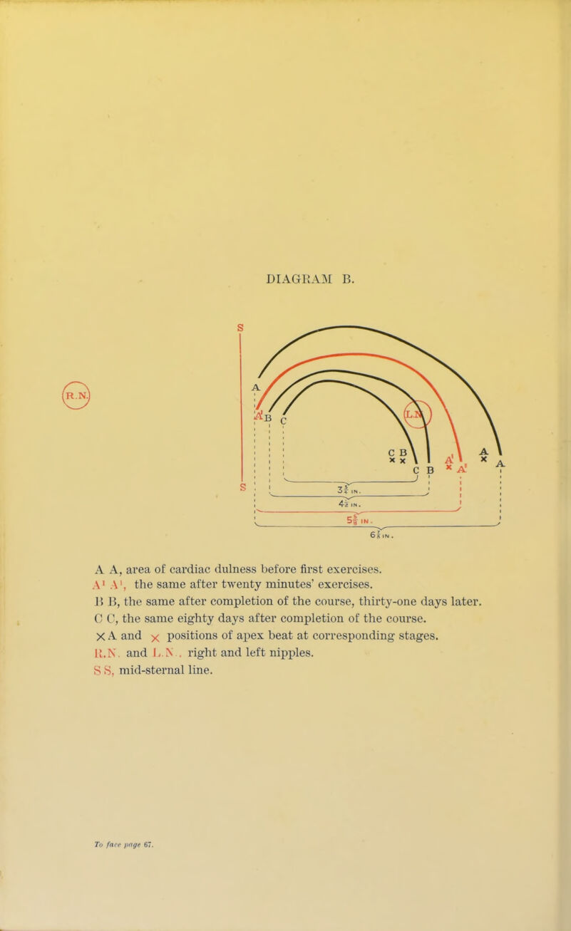 6 A tISt . A A, area of cardiac dulness before first exercises. A1 A1, the same after twenty minutes' exercises. I! P>, the same after completion of the course, thirty-one days later. CO, the same eighty days after completion of the course. X A and x positions of apex beat at corresponding stages. U.N. and L.N.. right and left nipples, s S. mid-sternal line. To face jinge 67.