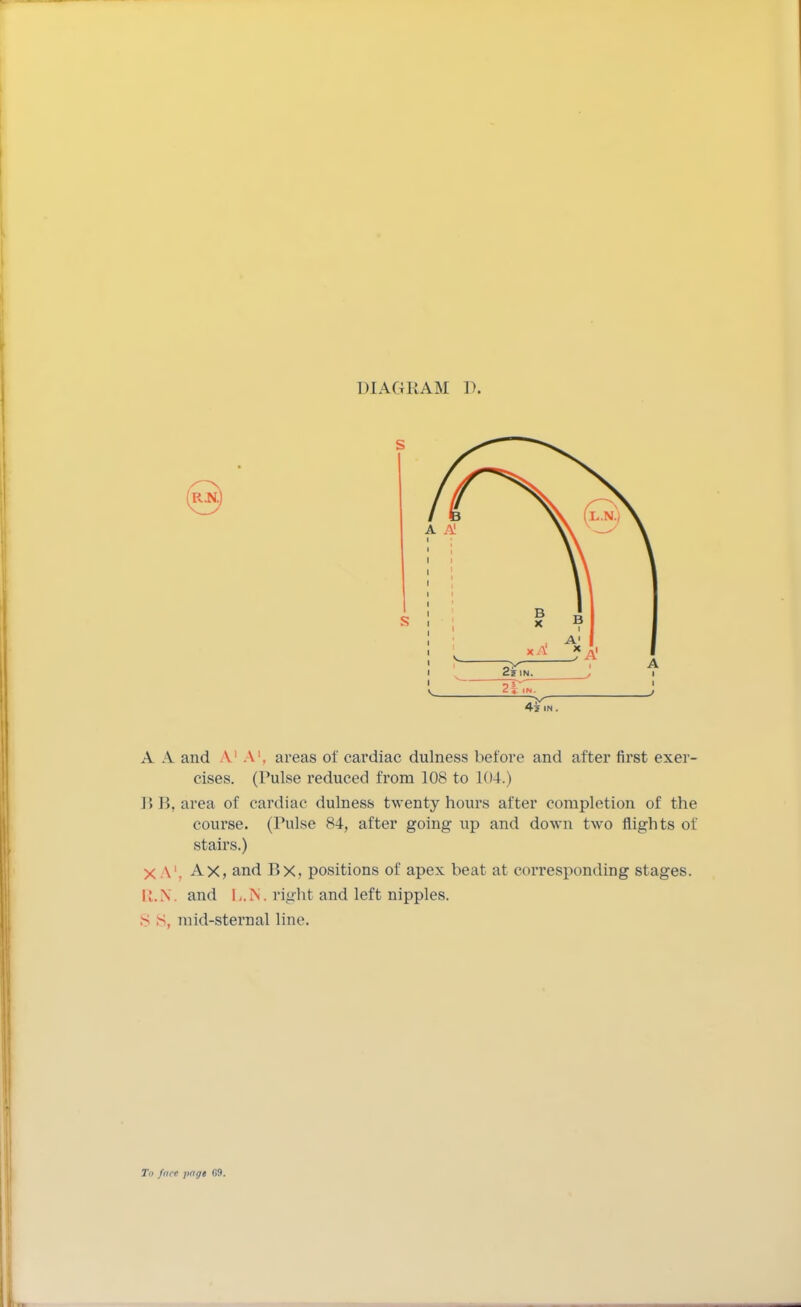 A A and V A1, areas of cardiac dulness before and after first exer- cises. (Pulse reduced from 108 to 104.) BB, area of cardiac dulness twenty hours after completion of the course. (Pulse 84, after going up and down two flights of stairs.) X A1. Ax, and P>x, positions of apex beat at corresponding stages. R.N. and IN . right and left nipples. - *}, mid-sternal line.