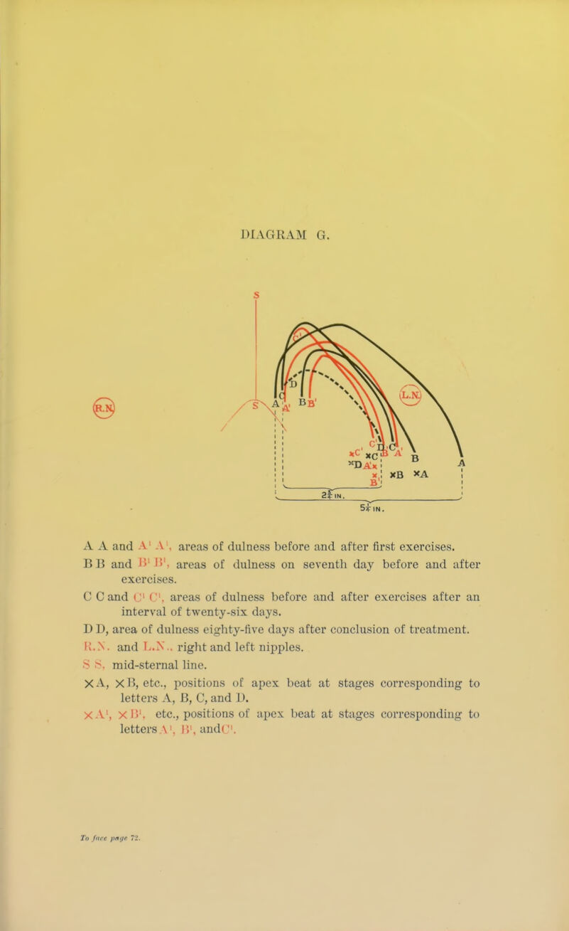 A A and A A . areas of dulness before and after first exercises. B B and '»! B1, areas of dulness on seventh day before and after exercises. C C and C C1, areas of dulness before and after exercises after an interval of twenty-six days. D D, area of dulness eighty-five days after conclusion of treatment. I!.N. and L.N., right and left nipples. S S, raid-sternal line. XA, xH, etc., positions of apex beat at stages corresponding to letters A, B, C, and I). XA\ XB1, etc., positions of apex beat at stages corresponding to letters A \ Bl, and<\ To face pai/f