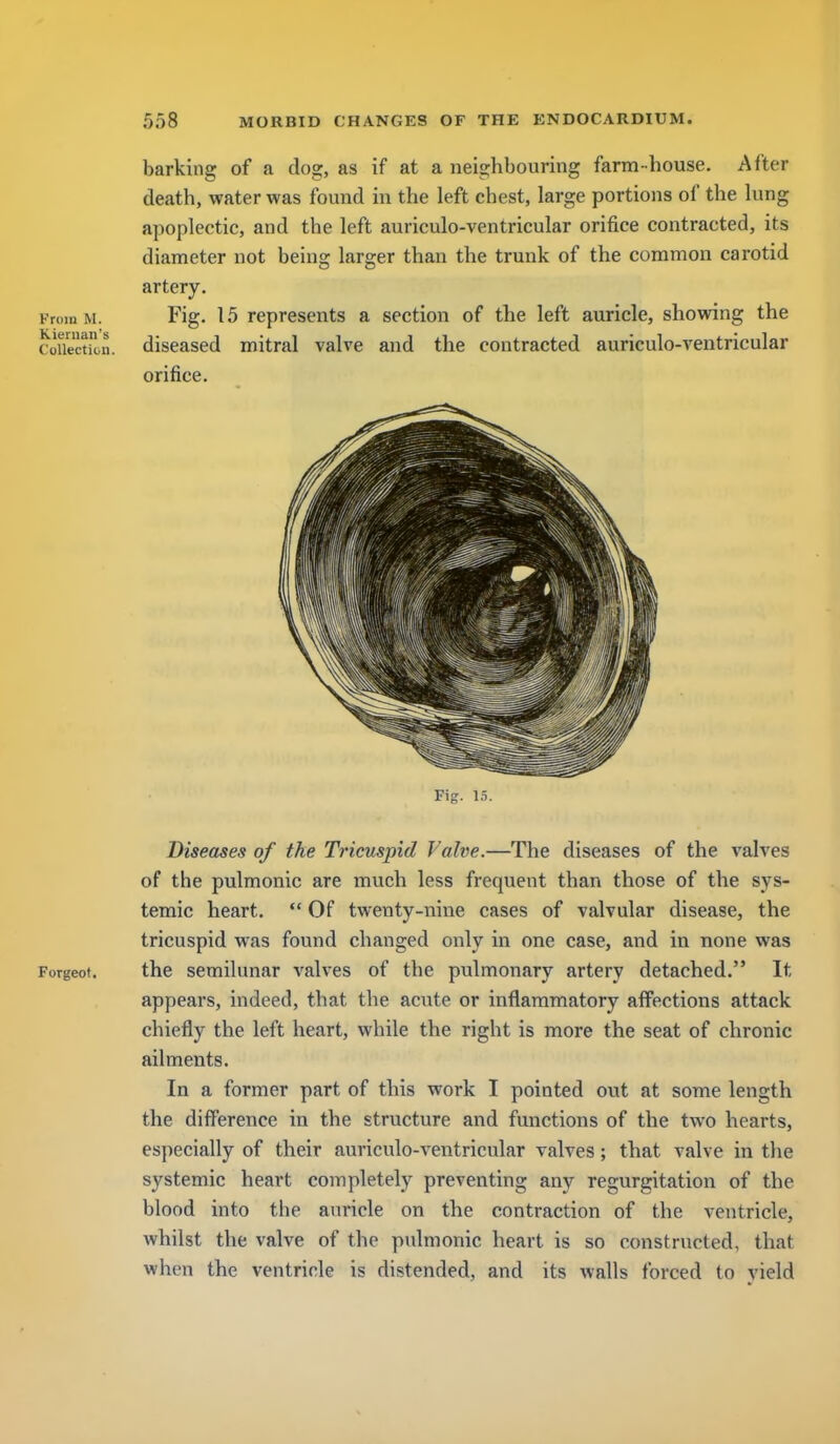 barking of a clog, as if at a neighbouring farm-house. After death, water was found in the left chest, large portions of the lung apoplectic, and the left auriculo-ventricular orifice contracted, its diameter not being larger than the trunk of the common carotid artery. From M. Fig. 15 represents a section of the left auricle, showing the CoUection. diseased mitral valve and the contracted auriculo-ventricular orifice. Fig. 15. Diseases of the Tricuspid Valve.—The diseases of the valves of the pulmonic are much less frequent than those of the sys- temic heart, Of twenty-nine cases of valvular disease, the tricuspid was found changed only in one case, and in none was Forgeot. the semilunar valves of the pulmonary artery detached. It appears, indeed, that the acute or inflammatory aflFections attack chiefly the left heart, while the right is more the seat of chronic ailments. In a former part of this work I pointed out at some length the diff'erence in the structure and functions of the two hearts, especially of their auriculo-ventricular valves; that valve in the systemic heart completely preventing any regurgitation of the blood into the auricle on the contraction of the ventricle, whilst the valve of the pulmonic heart is so constructed, that when the ventricle is distended, and its walls forced to yield