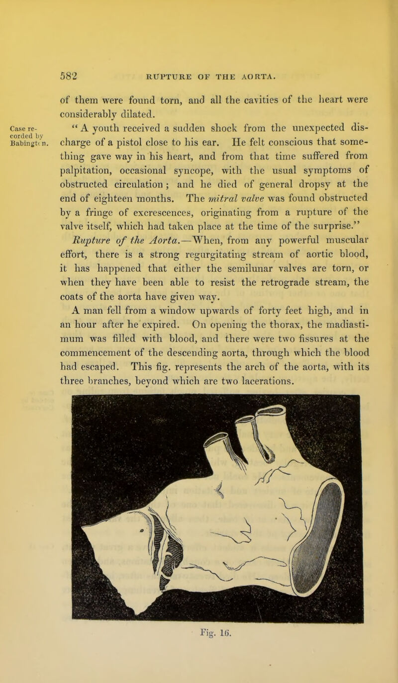 of them were found torn, and all the cavities of the heart were considerably dilated. Case re- A youth received a sudden shock from the miexpected dis- Bai)ingt( n. charge of a pistol close to his ear. He felt conscious that some- thing gave way in his heart, and from that time suffered from palpitation, occasional syncope, with the usual symptoms of obstructed circulation ; and he died of general dropsy at the end of eighteen months. The mitral valve was found obstructed by a fringe of excrescences, originating from a rupture of the valve itself, which had taken place at the time of the surprise. Rupture of the Aorta.—When, from any powerful muscular effort, there is a strong regurgitating stream of aortic blood, it has happened that either the semilunar valves are torn, or when they have been able to resist the retrograde stream, the coats of the aorta have given way, A man fell from a window upwards of forty feet high, and in an hour after he expired. On opening the thorax, the madiasti- mum was filled with blood, and there were two fissures at the commencement of the descending aorta, through which the blood had escaped. This fig. represents the arch of the aorta, with its three branches, beyond which are two lacerations.