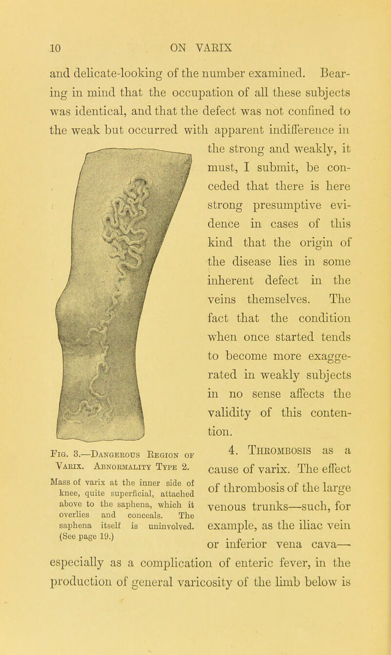and delicate-looking of the number examined. Bear- ing in mind that the occupation of all these subjects was identical, and that the defect was not confined to the weak but occurred with apparent indifference in the strong and weakly, it must, I submit, be con- ceded that there is here strong presumptive evi- dence in cases of this kind that the origin of the disease lies in some inherent defect in the veins themselves. The fact that the condition when once started tends to become more exagge- rated in weakly subjects in no sense affects the validity of this conten- tion. 4. Thrombosis as a cause of varix. The effect of thrombosis of the large venous trunks—such, for example, as the iliac vein or inferior vena cava—> especially as a complication of enteric fever, in the production of general varicosity of the limb below is Fig. 3.—Dangerous Eegion of Varix. Abnormality Type 2. Mass of varix at the inner side of knee, quite superficial, attached above to the saphena, which it overlies and conceals. The saphena itself is uninvolved. (See page 19.)