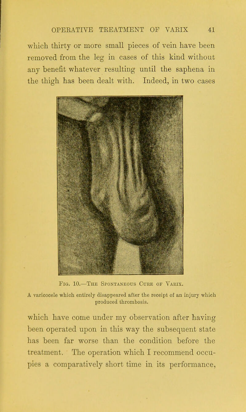 which thirty or more small pieces of vein have been removed from the leg in cases of this kind without any benefit whatever resulting until the saphena in the thigh has been dealt with. Indeed, in two cases Fig. 10.—The Spontaneous Cure of Vakix. A varicocele which entirely disappeared after the receipt of an injury which produced thrombosis. which have come under my observation after having been operated upon in this way the subsequent state has been far worse than the condition before the treatment. The operation which I recommend occu- pies a comparatively short time in its performance,