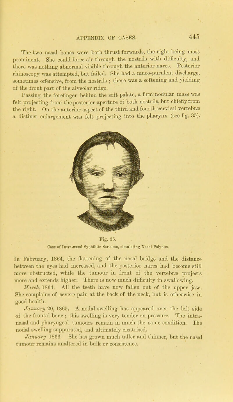 The two nasal bones were both thrust forwards, the right being most prominent. She could force air through the nostrils with difficulty, and there was nothing abnormal visible through the anterior nares. Posterior rhinoscopy was attempted, but failed. She had a muco-purulent discharge, sometimes offensive, from the nostrils ; there was a softening and yielding of the front part of the alveolar ridge. Passing the forefinger behind the soft palate, a firm nodular mass was felt projecting from the posterior aperture of both nostrils, but chiefly from the right. On the anterior aspect of the third and fourth cervical vertebra? a distinct enlargement was felt projecting into the pharynx (see fig. 35). Fig. 35. Case of Intra-nasal Syphilitic Sarcoma, simulating Nasal Polypus. In February, 1864, the flattening of the nasal bridge and the distance between the eyes had increased, and the posterior nares had become still more obstructed, while the tumour in front of the vertebrae projects more and extends higher. There is now much difficulty in swallowing. March, 1864. All the teeth have now fallen out of the upper jaw. She complains of severe pain at the back of the neck, but is otherwise in good health. January 20, 1865. A nodal swelling has appeared over the left side of the frontal bone ; this swelling is very tender on pressure. The intra- nasal and pharyngeal tumours remain in much the same condition. The nodal swelling suppurated, and ultimately cicatrised. January 1866. She has grown much taller and thinner, but the nasal tumour remains unaltered in bulk or consistence.