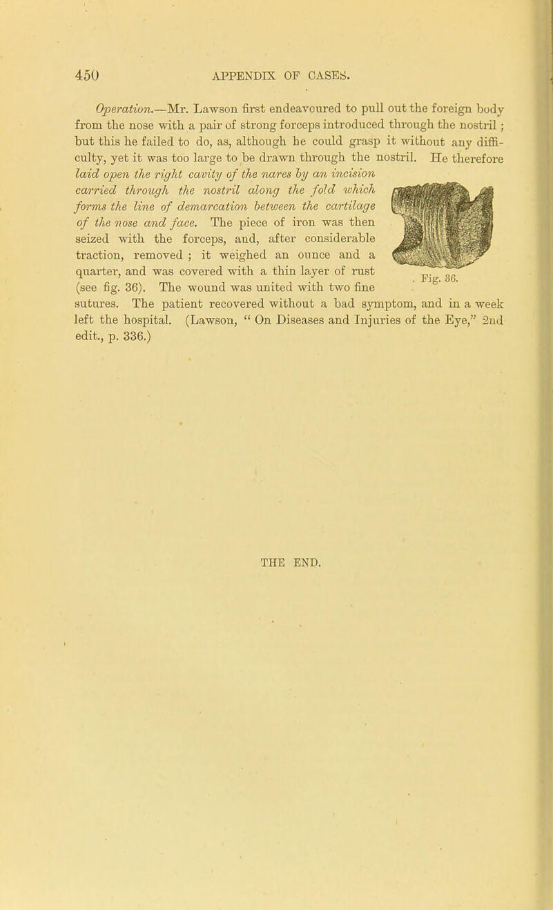 Operation.—Mr. Lawson first endeavoured to pull out the foreign body from the nose with a pair of strong forceps introduced through the nostril; but this he failed to do, as, although he could grasp it without any diffi- culty, yet it was too large to be drawn through the nostril. He therefore laid open the right cavity of the nares by an incision carried through the nostril along the fold which forms the line of demarcation between the cartilage of the nose and face. The piece of iron was then seized with the forceps, and, after considerable traction, removed ; it weighed an ounce and a quarter, and was covered with a thin layer of rust (see fig. 36). The wound was united with two fine sutures. The patient recovered without a bad symptom, and in a week left the hospital. (Lawson,  On Diseases and Injuries of the Eye, 2nd edit, p. 336.) THE END.