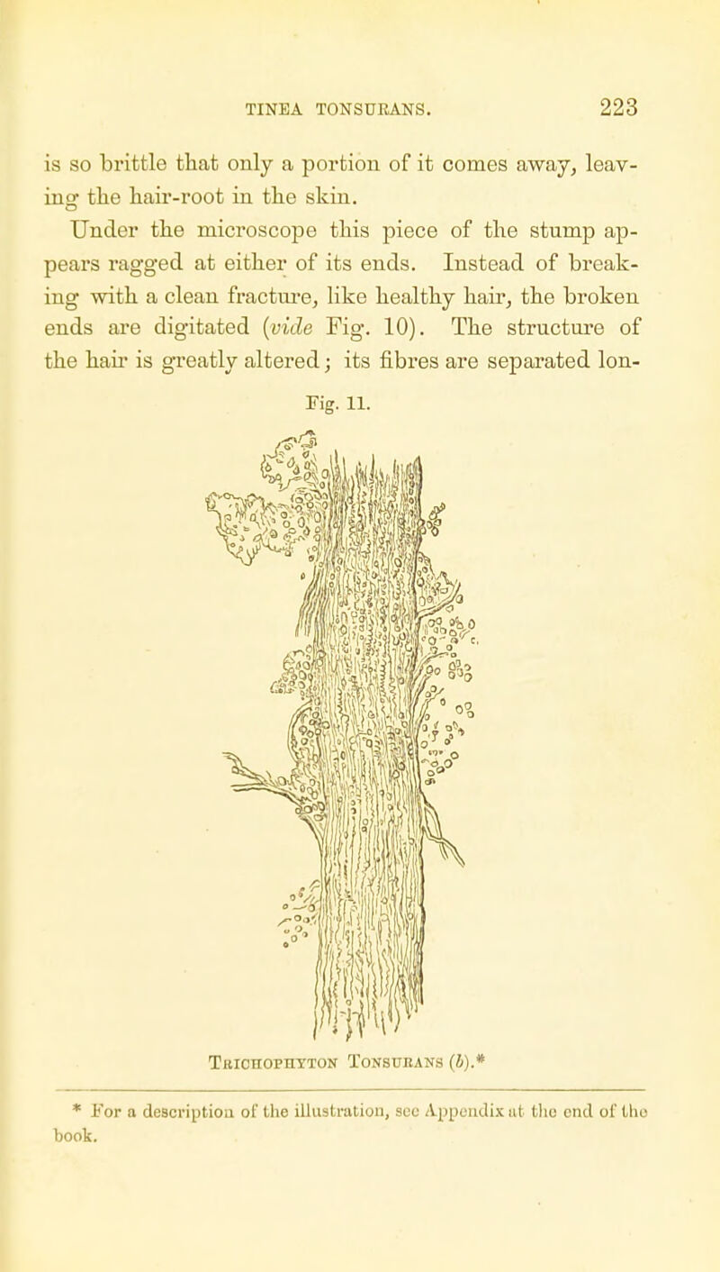 is so brittle that only a portion of it comes away, leav- ing the hair-root in the skin. Under the microscope this piece of the stump ap- pears ragged at either of its ends. Instead of break- ing with a clean fracture., like healthy hair, the broken ends are digitated (vide Fig. 10). The structure of the hair is greatly altered; its fibres are separated lon- TuicnopnYTON Tonsuhans (J).* * For a description of the illustration, see Appendix at the end of the book.