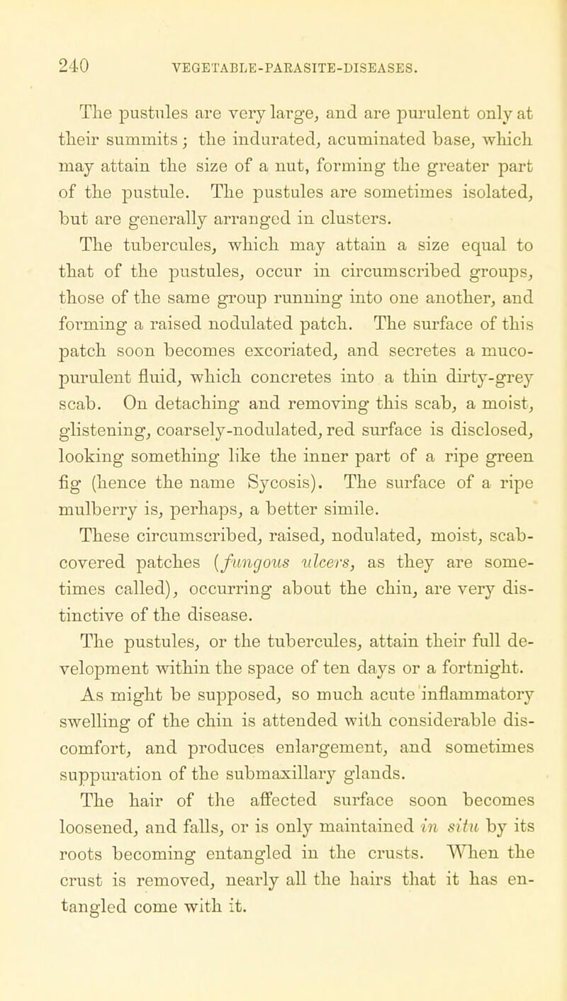 The pustules are very large, and are purulent only at their summits; the indurated, acuminated base, which may attain the size of a nut, forming the greater part of the pustule. The pustules are sometimes isolated, but are generally arranged in clusters. The tubercules, which may attain a size equal to that of the pustules, occur in circumscribed groups, those of the same group running into one another, and forming a raised nodulated patch. The surface of this patch soon becomes excoriated, and secretes a muco- purulent fluid, which concretes into a thin dirty-grey scab. On detaching and removing this scab, a moist, glistening, coarsely-nodulated, red surface is disclosed, looking something like the inner part of a ripe green fig (hence the name Sycosis). The surface of a ripe mulberry is, perhaps, a better simile. These circumscribed, raised, nodulated, moist, scab- covered patches [fungous ulcers, as they are some- times called), occurring about the chin, are very dis- tinctive of the disease. The pustules, or the tubercules, attain their full de- velopment within the space of ten days or a fortnight. As might be supposed, so much acute inflammatory swelling of the chin is attended with considerable dis- comfort, and produces enlargement, and sometimes suppuration of the submaxillary glands. The hair of the affected surface soon becomes loosened, and falls, or is only maintained in situ by its roots becoming entangled in the crusts. When the crust is removed, nearly all the hairs that it has en- tangled come with it.