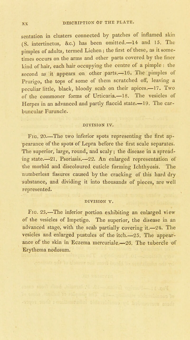 sentation in clusters connected by patches of inflamed skin (S. intertinctus, &c.) has been omitted.—14 and 15. The pimples of adults^ termed Lichen; the first of these, as it some- times occurs on the arms and other parts covered by the finer kind of hair, each hair occupying the centre of a pimple ; the second as it appears on other parts.—16. The pimples of Prurigo, the tops of some of them scratched off, leaving a peculiar little, black, bloody scab on their apices.—17. Two of the commoner forms of Urticaria.—18, The vesicles of Herpes in an advanced and partly flaccid state.—19. The car- buncular Furuncle. DIVISION IV, Fig, 20—The two inferior spots representing the first ap- pearance of the spots of Lepra before the first scale separates. The superior, large, round, and scaly; the disease in a spread- ing state.—21. Psoriasis.—22. An enlarged representation of the morbid and discoloured cuticle forming Ichthyosis. The numberless fissures caused by the cracking of this hard dry substance, and dividing it into thousands of pieces, are well represented. DIVISION V. Fig, 23.—The inferior portion exhibiting an enlarged view of the vesicles of Impetigo. The superior, the disease in an advanced stage, with the scab partially covering it,—24. The vesicles and enlarged pustules of the itch.—25. The appear- ance of the skin in Eczema mercuriale.—26. The tubercle of Erythema nodosum.