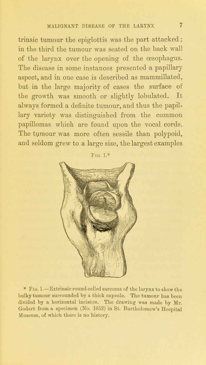trinsic tumour the epiglottis was the part attacked; in the third the tumour was seated on the back wall of the larynx over the opening of the oesophagus. The disease in some instances presented a papillary aspect, and in one case is described as mammillated, but in the large majority of cases the surface of the growth was smooth or slightly lobulated. It always formed a definite tumour, and thus the papil- lary variety was distinguished from the common papillomas which are found upon the vocal cords. The tumour was more often sessile than polypoid, and seldom grew to a large size, the largest examples Fig. 1* * Fio. 1.—Extrinsic round-celled sarcoma of the larynx to sbow the bulky tumour surrounded by a thick capsule. The tumour has been divided by a horizontal incision. The di'awing was made by Mr. Godart from a specimen (No. 1653) in St. Bartholomew's Hospital Museum, of which there is no history.