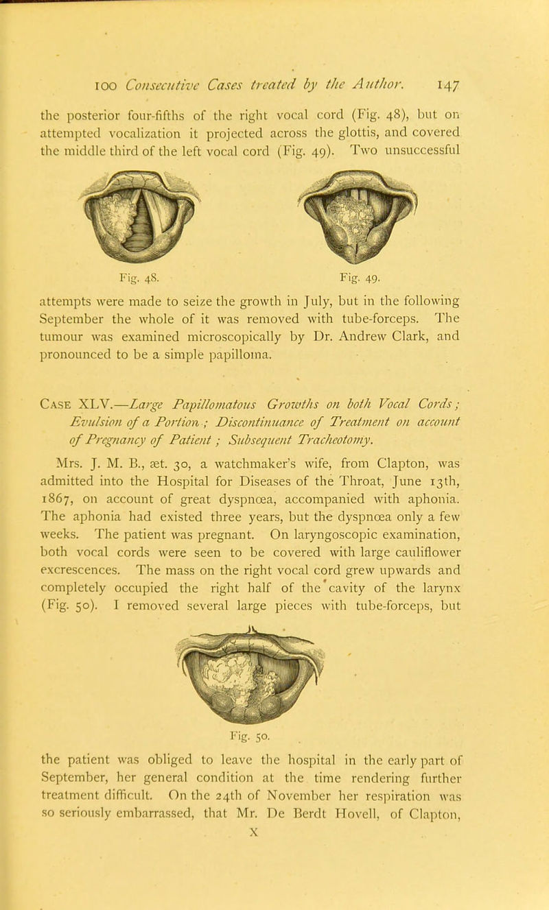 the posterior four-fifths of the right vocal cord (Fig. 48), but on attempted vocalization it projected across the glottis, and covered the middle third of the left vocal cord (Fig. 49). Two unsuccessful Fig. 48. Fig. 49. attempts were made to seize the growth in July, but in the following September the whole of it was removed with tube-forceps. The tumour was examined microscopically by Dr. Andrew Clark, and pronounced to be a simple papilloma. Case XLV.—Large Papillomatous Growths on both Vocal Cords; Evulsion of a Portion ; Discontinuance of Treatment on account of Pregnancy of Patient; Subsequent Tracheotomy. Mrs. J. M. B., set. 30, a watchmaker's wife, from Clapton, was admitted into the Hospital for Diseases of the Throat, June 13th, 1867, on account of great dyspnoea, accompanied with aphonia. The aphonia had existed three years, but the dyspnoea only a few weeks. The patient was pregnant. On laryngoscopic examination, both vocal cords were seen to be covered with large cauliflower excrescences. The mass on the right vocal cord grew upwards and completely occupied the right half of the cavity of the larynx (Fig. 50). I removed several large pieces with tube-forceps, but Fig. S°- the patient was obliged to leave the hospital in the early part of September, her general condition at the time rendering further treatment difficult. On the 24th of November her respiration was so seriously embarrassed, that Mr. De Berdt Hovell, of Clapton, X