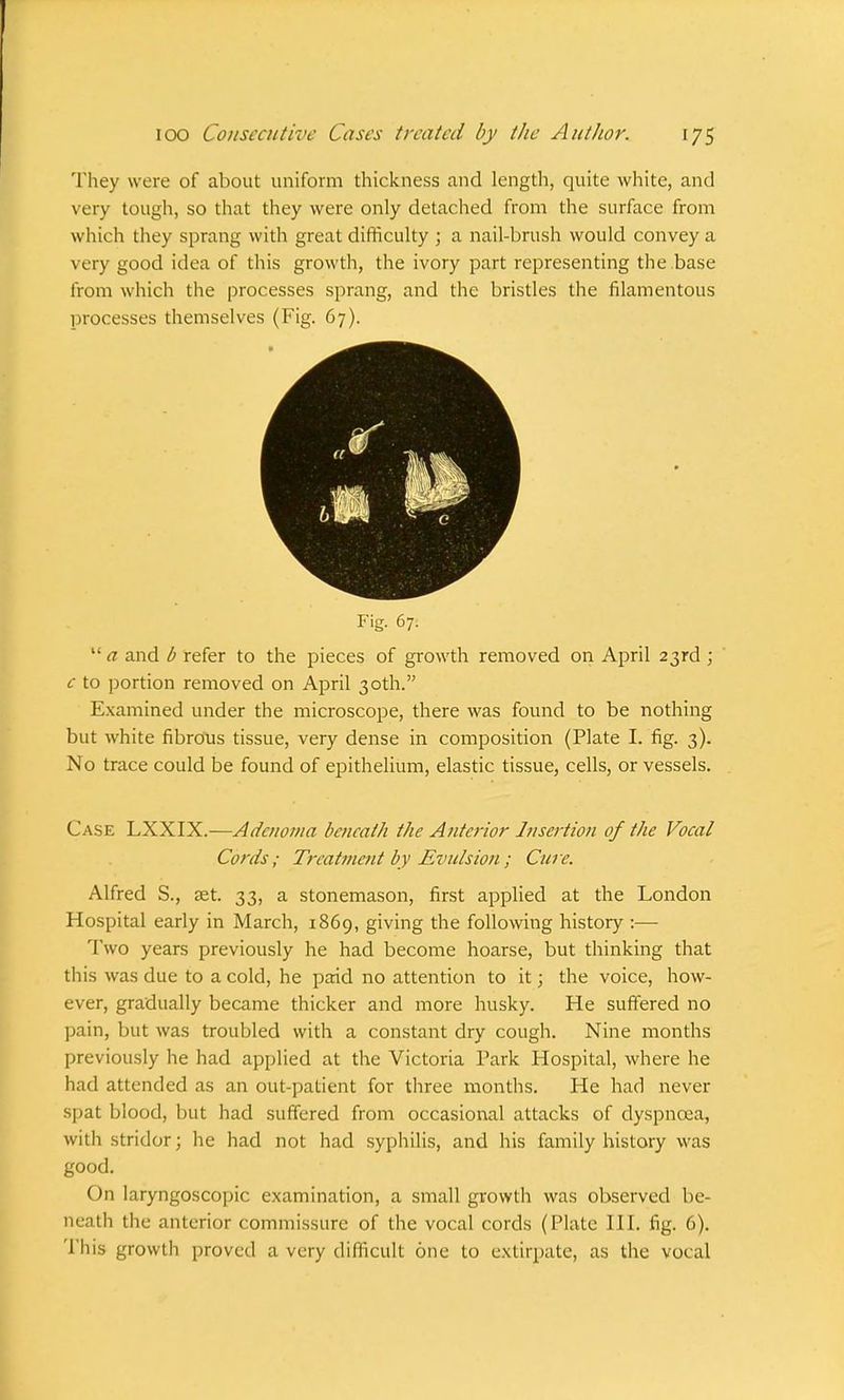 They were of about uniform thickness and length, quite white, and very tough, so that they were only detached from the surface from which they sprang with great difficulty ; a nail-brush would convey a very good idea of this growth, the ivory part representing the base from which the processes sprang, and the bristles the filamentous processes themselves (Fig. 67). Fig. 67.  a and b refer to the pieces of growth removed on April 23rd ; c to portion removed on April 30th. Examined under the microscope, there was found to be nothing but white fibrous tissue, very dense in composition (Plate I. fig. 3). No trace could be found of epithelium, elastic tissue, cells, or vessels. Case LXXIX.—Adenoma beneath the Anterior Insertion of the Vocal Cords; Treatment by Evulsion; Cure. Alfred S., set. 33, a stonemason, first applied at the London Hospital early in March, 1869, giving the following history :—■ Two years previously he had become hoarse, but thinking that this was due to a cold, he paid no attention to it; the voice, how- ever, gradually became thicker and more husky. He suffered no pain, but was troubled with a constant dry cough. Nine months previously he had applied at the Victoria Park Hospital, where he had attended as an out-patient for three months. He had never spat blood, but had suffered from occasional attacks of dyspncea, with stridor; he had not had syphilis, and his family history was good. On laryngoscopic examination, a small growth was observed be- neath the anterior commissure of the vocal cords (Plate III. fig. 6). This growth proved a very difficult one to extirpate, as the vocal