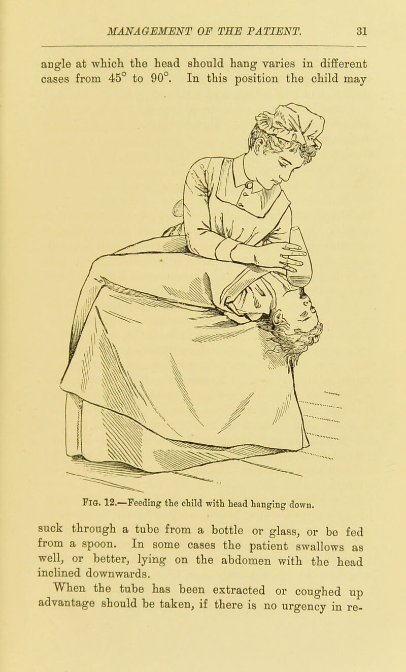 angle at wliicli the head should hang varies in different cases from 45° to 90°. In this position the child may Fig. 12.-—Feeding the child with head hanging down. suck through a tube from a bottle or glass, or be fed from a spoon. In some cases the patient swallows as well, or better, lying on the abdomen with the head inclined downwards. When the tube has been extracted or coughed up advantage should be taken, if there is no urgency in re-