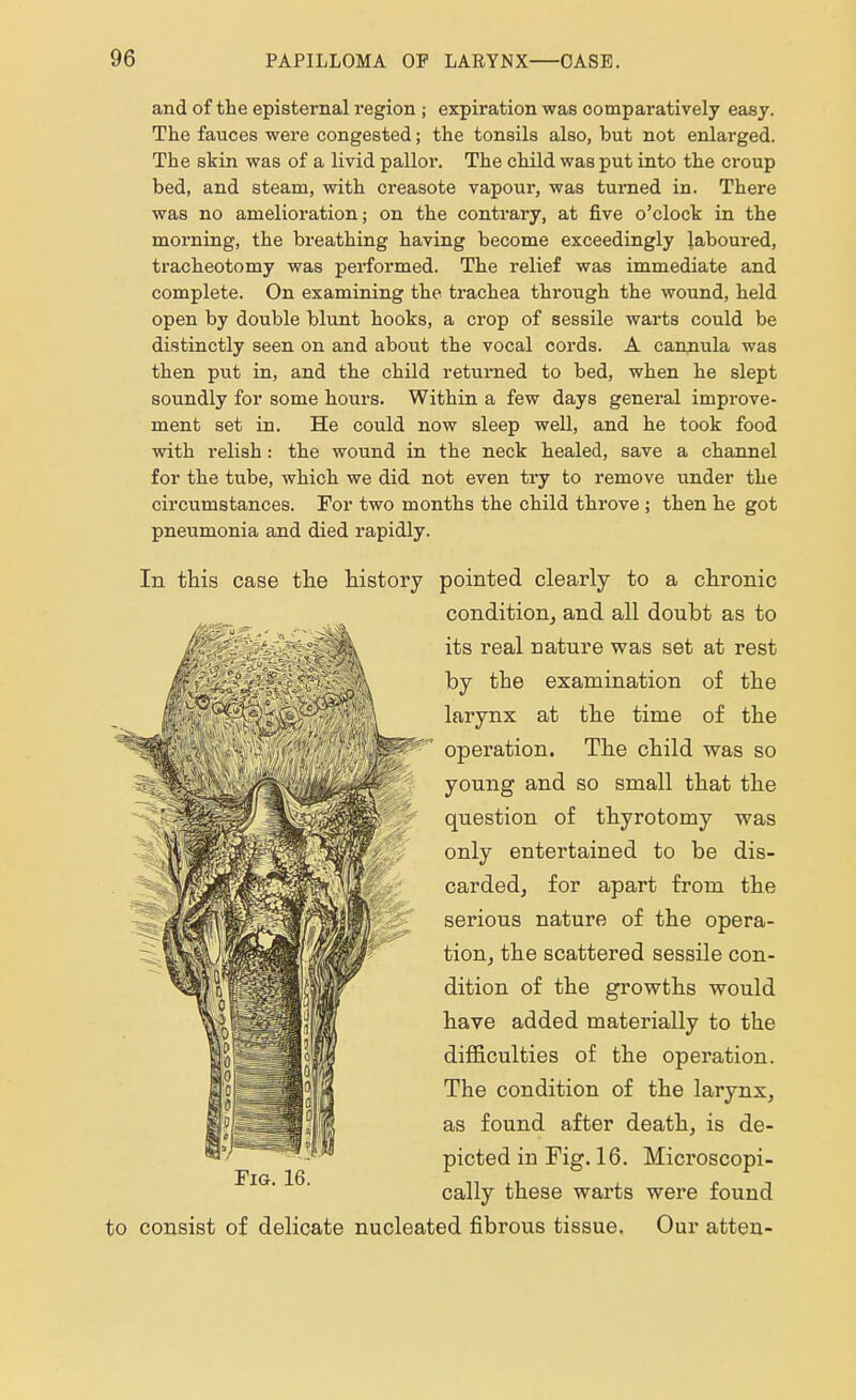 and of the episternal region ; expiration was comparatively easy. The fauces were congested; the tonsils also, but not enlarged. The skin was of a livid pallor. The child was put into the croup bed, and steam, with creasote vapour, was turned in. There was no amelioration; on the contrary, at five o'clock in the morning, the breathing having become exceedingly laboured, tracheotomy was performed. The relief was immediate and complete. On examining the trachea through the wound, held open by double blunt hooks, a crop of sessile warts could be distinctly seen on and about the vocal cords. A cannula was then put in, and the child returned to bed, when he slept soundly for some hours. Within a few days general improve- ment set in. He could now sleep well, and he took food with relish: the wound in the neck healed, save a channel for the tube, which we did not even try to remove under the circumstances. For two months the child throve ; then he got pneumonia and died rapidly. In this case the history pointed clearly to a chronic condition, and all doubt as to its real nature was set at rest by the examination of the larynx at the time of the operation. The child was so young and so small that the question of thyrotomy was only entertained to be dis- carded, for apart from the serious nature of the opera- tion, the scattered sessile con- dition of the growths would have added materially to the difficulties of the operation. The condition of the larynx, as found after death, is de- picted in Fig. 16. Microscopi- cally these warts were found to consist of delicate nucleated fibrous tissue. Our atten- Fig. 16.