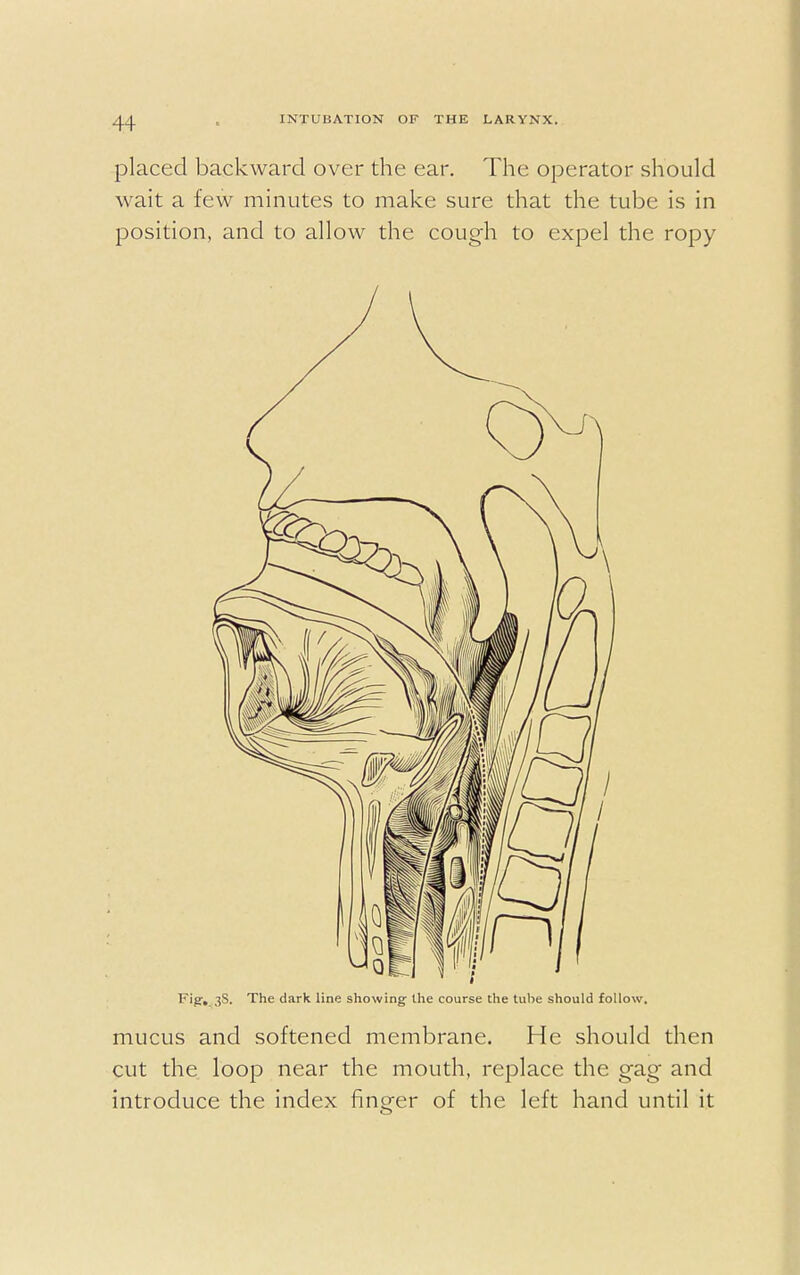 placed backward over the ear. The operator should wait a few minutes to make sure that the tube is in position, and to allow the cough to expel the ropy Fig. 3S. The dark line showing the course the tube should follow. mucus and softened membrane. He should then cut the loop near the mouth, replace the gag and introduce the index finger of the left hand until it