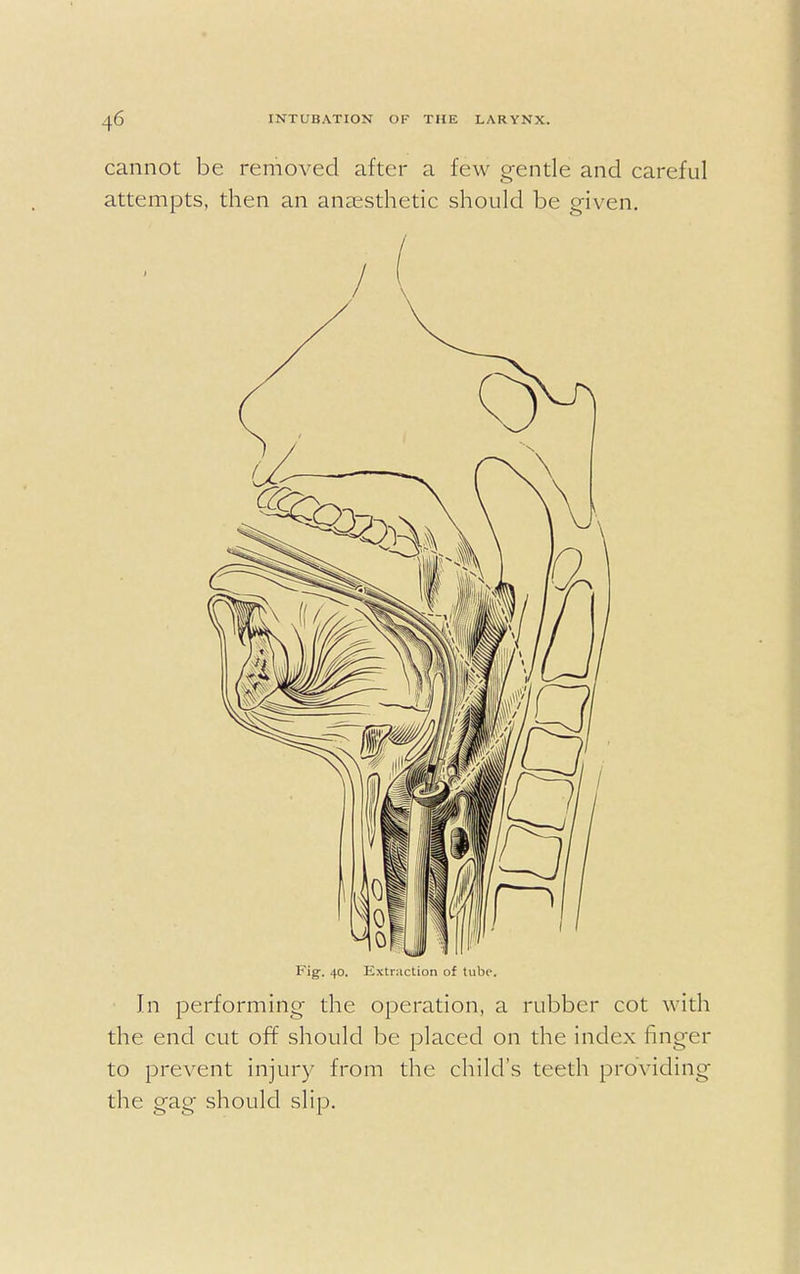 cannot be removed after a few gentle and careful attempts, then an anaesthetic should be given. Fig-. 40. Extraction of tube. In performing the operation, a rubber cot with the end cut off should be placed on the index finger to prevent injury from the child's teeth providing the gag should slip.