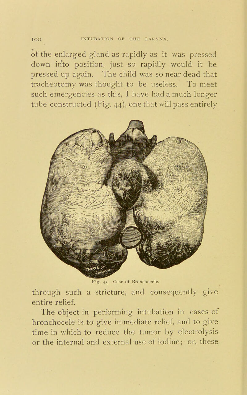 of the enlarged gland as rapidly as it was pressed down into position, just so rapidly would it be pressed up again. The child was so near dead that tracheotomy was thought to be useless. To meet such emergencies as this, I have had a much longer tube constructed (Fig. 44), one that will pass entirely Fig. 45. Case of Bronchocele. through such a stricture, and consequently give entire relief. The object in performing intubation in cases of bronchocele is to give immediate relief, and to give time in which to reduce the tumor by electrolysis or the internal and external use of iodine; or, these