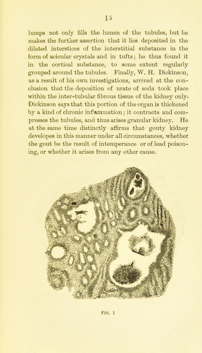 lumps not only fills the lumen of the tubules, but he makes the further assertion that it lies deposited in the dilated interstices of the interstitial substance in the form of acicular crystals and in tufts; he thus found it in the cortical substance, to some extent regularly grouped around the tubules. Finally, W. H. Dickinson, as a result of his own investigations, arrived at the con- clusion that the deposition of urate of soda took place within the inter-tubular fibrous tissue of the kidney only. Dickinson says that this portion of the organ is thickened by a kind of chronic inflammation; it contracts and com- presses the tubules, and thus arises granular kidney. He at the same time distinctly affirms that gouty kidney developes in this manner under all circumstances, whether the gout be the result of intemperance or of lead poison- ing, or whether it arises from any other cause. Fia. l