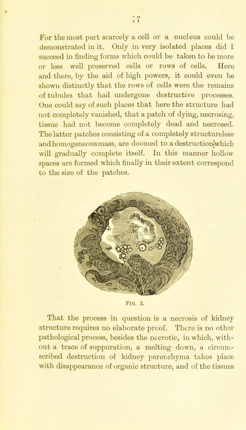 For the most part scarcely a cell or a nucleus could be demonstrated in it. Only in very isolated places did I succeed in finding forms which could be taken to be more or less well preserved cells or rows of cells. Here and there, by the aid of high powers, it could even be shown distinctly that the rows of cells were the remains of tubules that had undergone destructive processes. One could say of such places that here the structure had not completely vanished, that a patch of dying, necrosing, tissue had not become completely dead and necrosed. The latter patches consisting of a completely structureless and homogeneous mass, are doomed to a destructionjwhich will gradually complete itself. In this manner hollow spaces are formed which finally in their extent correspond to the size of the patches. Fia. 3. That the process in question is a necrosis of kidney structure requires no elaborate proof. There is no other pathological process, besides the necrotic, in which, with- out a trace of suppuration, a melting down, a circum- scribed destruction of kidney parenchyma takes place with disappearance of organic structure, and of the tissues