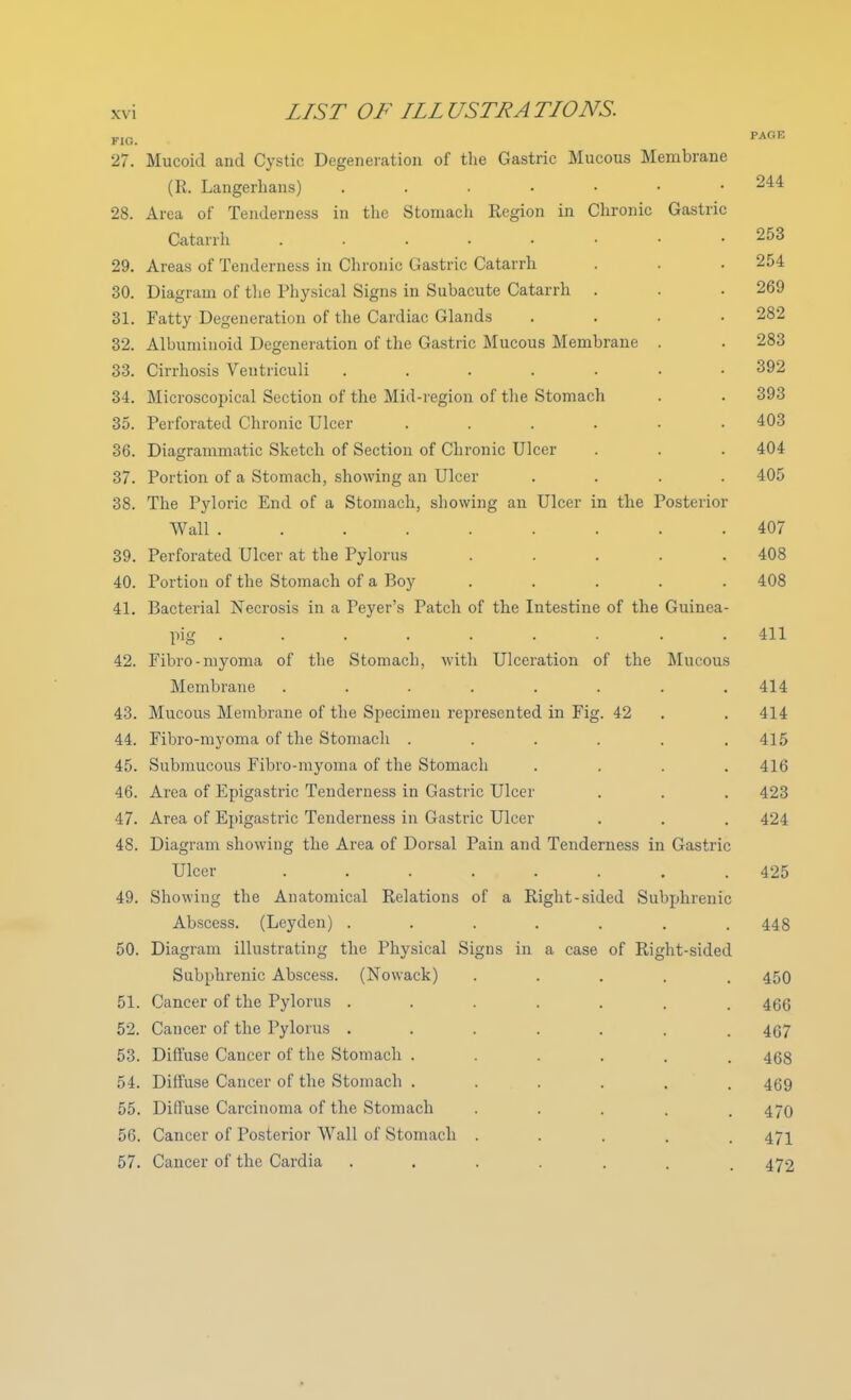 FIG. PAGE 27. Mucoid and Cystic Degeneration of the Gastric Mucous Membrane (R. Langerhans) 244 28. Area of Tenderness in the Stomach Region in Chronic Gastric Catarrh .253 29. Areas of Tenderness in Chronic Gastric Catarrh . . . 254 30. Diagram of the Physical Signs in Subacute Catarrh . . . 269 31. Fatty Degeneration of the Cardiac Glands .... 282 32. Albuminoid Degeneration of the Gastric Mucous Membrane . . 283 33. Cirrhosis Veutriculi 392 34. Microscopical Section of the Mid-region of the Stomach . . 393 35. Perforated Chronic Ulcer ...... 403 36. Diagrammatic Sketch of Section of Chronic Ulcer . . . 404 37. Portion of a Stomach, showing an Ulcer .... 405 38. The Pyloric End of a Stomach, showing an Ulcer in the Posterior Wall ......... 407 39. Perforated Ulcer at the Pylorus . . . . .408 40. Portion of the Stomach of a Boy ..... 408 41. Bacterial Necrosis in a Peyer's Patch of the Intestine of the Guinea- pig ......... 411 42. Fibro-myoma of the Stomach, with Ulceration of the Mucous Membrane ........ 414 43. Mucous Membrane of the Specimen represented in Fig. 42 . . 414 44. Fibro-myoma of the Stomach . . . . . .415 45. Submucous Fibro-myoma of the Stomach .... 416 46. Area of Epigastric Tenderness in Gastric Ulcer . . . 423 47. Area of Epigastric Tenderness in Gastric Ulcer . . . 424 48. Diagram showing the Area of Dorsal Pain and Tenderness in Gastric Ulcer ........ 425 49. Showing the Anatomical Relations of a Right-sided Subphrenic Abscess. (Leyden) ....... 448 50. Diagram illustrating the Physical Signs in a case of Right-sided Subphrenic Abscess. (Nowack) ..... 450 51. Cancer of the Pylorus ....... 466 52. Cancer of the Pylorus ....... 467 53. Diffuse Cancer of the Stomach ...... 453 54. Diffuse Cancer of the Stomach ...... 459 55. Diffuse Carcinoma of the Stomach . 470 56. Cancer of Posterior Wall of Stomach ..... 471 57. Cancer of the Cardia ....... 472