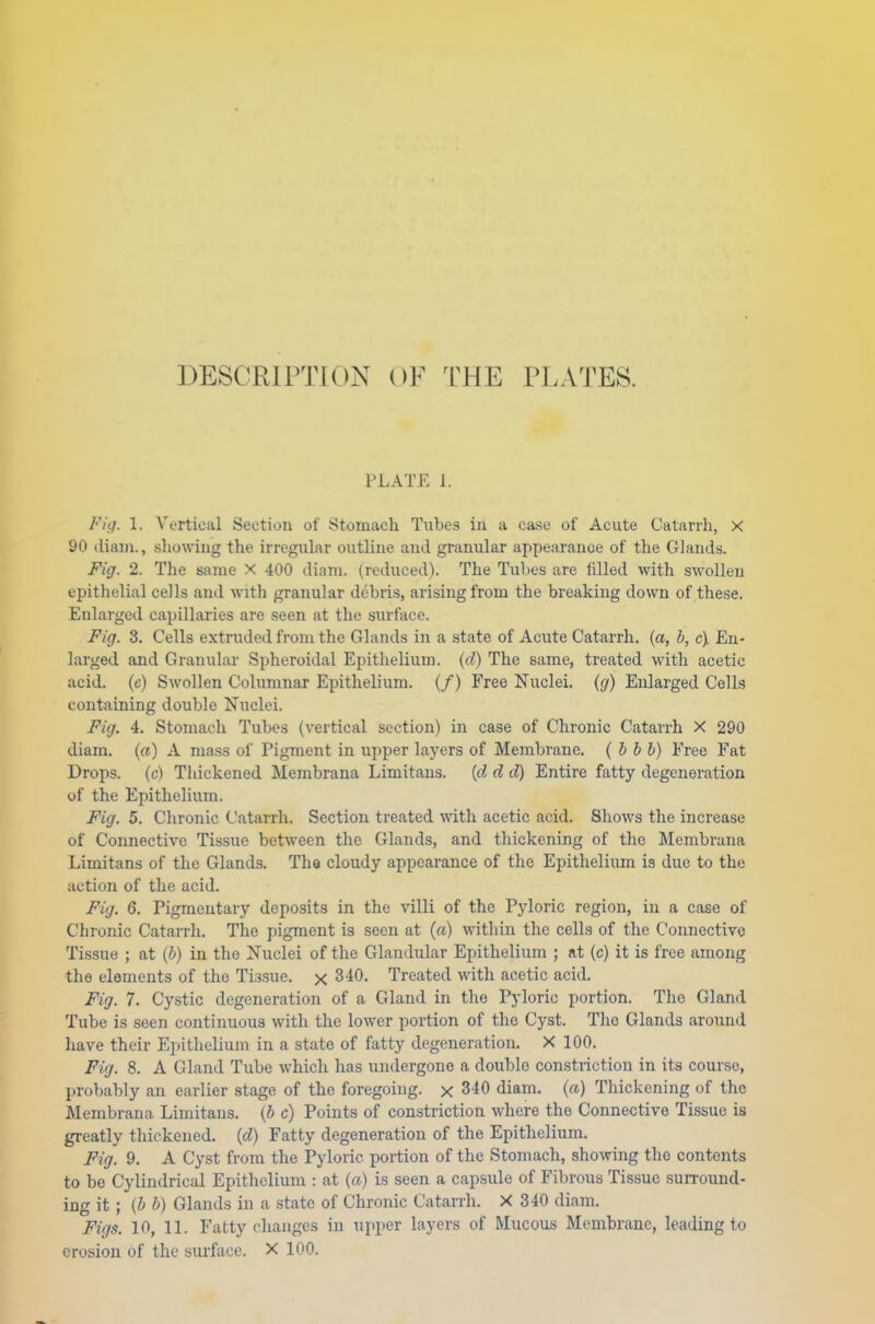 DESCRIPTION OF THE PLATES. PLATE I. Fig. I, Vertical Section of Stomach Tubes in a case of Acute Catarrh, x 90 diam., showing the irregular outline and granular appearance of the Glands. Fig. 2. The same X 400 diam. (reduced). The Tubes are filled with swollen epithelial cells and with granular debris, arising from the breaking down of these. Enlarged capillaries are seen at the surface. Fig. 3. Cells extruded from the Glands in a state of Acute Catarrh, (a, b, c\ En- larged and Granular Spheroidal Epithelium, (d) The same, treated with acetic acid, (c) Swollen Columnar Epithelium. (/) Free Nuclei, (g) Enlarged Cells containing double Nuclei. Fig. 4. Stomach Tubes (vertical section) in case of Chronic Catarrh X 290 diam. (a) A mass of Pigment in upper layers of Membrane. ( b b b) Free Fat Drops, (c) Thickened Membrana Limitans. (d d d) Entire fatty degeneration of the Epithelium. Fig. 5. Chronic Catarrh. Section treated with acetic acid. Shows the increase of Connective Tissue between the Glands, and thickening of the Membrana Limitans of the Glands. The cloudy appearance of the Epithelium is due to the action of the acid. Fig. 6. Pigmentary deposits in the villi of the Pyloric region, in a case of Chronic Catarrh. The pigment is seen at (ft) within the cells of the Connective Tissue ; at (b) in the Nuclei of the Glandular Epithelium ; at (c) it is free among the elements of the Tissue, x 3 40. Treated with acetic acid. Fig. 7. Cystic degeneration of a Gland in the Pyloric portion. The Gland Tube is seen continuous with the lower portion of the Cyst. Tho Glands around have their Epithelium in a state of fatty degeneration. X 100. Fig. 8. A Gland Tube which has undergone a double constriction in its course, probably an earlier stage of the foregoing, x 340 diam. (a) Thickening of the Membrana. Limitans. (b c) Points of constriction where the Connective Tissue is greatly thickened, {d) Fatty degeneration of the Epithelium. Fig. 9. A Cyst from the Pyloric portion of the Stomach, showing the contents to be Cylindrical Epithelium : at (a) is seen a capsule of Fibrous Tissue surround- ing it ; (b b) Glands in a state of Chronic Catarrh. X 340 diam. Figs. 10, 11. Fatty changes in upper layers of Mucous Membrane, leading to