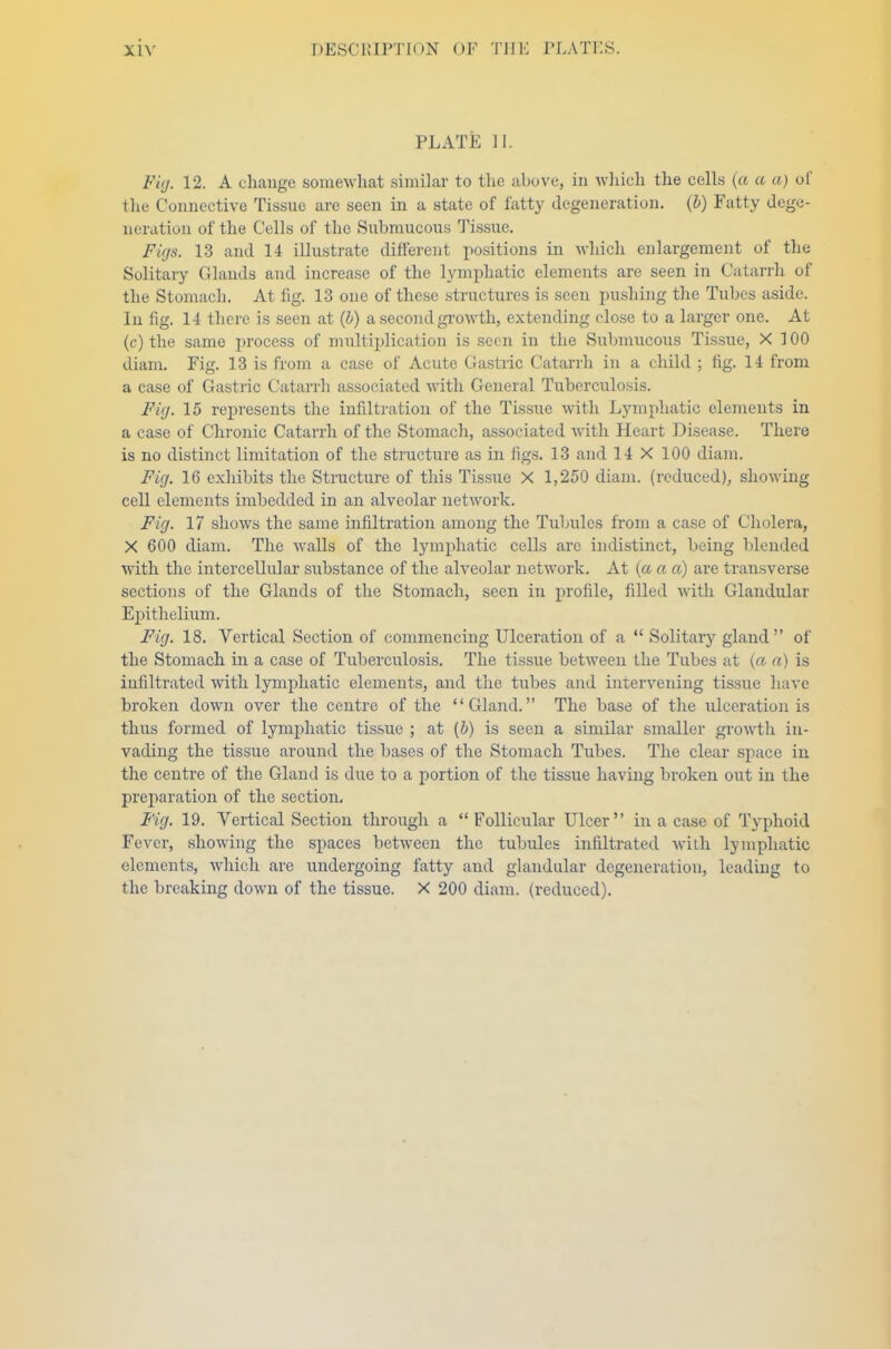 PLATE II. Fig. 12. A change somewhat similar to the above, in which the cells (a a a) of the Connective Tissue are seen in a state of fatty degeneration. (I) Fatty dege- neration of the Cells of the Submucous Tissue. Figs. 13 and 14 illustrate different positions in which enlargement of the Solitary Glands and increase of the lymphatic elements are seen in Catarrh of the Stomach. At fig. 13 one of these structures is seen pushing the Tubes aside. In fig. 14 there is seen at (b) a second growth, extending close to a larger one. At (c) the same process of multiplication is seen in the Submucous Tissue, X 100 diam. Fig. 13 is from a case of Acute Gastric Catarrh in a child ; fig. 14 from a case of Gastric Catarrh associated with General Tuberculosis. FUj. 15 represents the infiltration of the Tissue with Lymphatic elements in a case of Chronic Catarrh of the Stomach, associated with Heart Disease. There is no distinct limitation of the structure as in figs. 13 and 14 X 100 diam. Fig. 16 exhibits the Structure of this Tissue X 1,250 diam. (reduced), showing cell elements imbedded in an alveolar network. Fig. 17 shows the same infiltration among the Tubules from a case of Cholera, X 600 diam. The walls of the lymphatic cells are indistinct, being blended with the intercellular substance of the alveolar network. At (a a a) are transverse sections of the Glands of the Stomach, seen in profile, filled with Glandular Epithelium. Fig. 18. Vertical Section of commencing Ulceration of a  Solitary gland of the Stomach in a case of Tuberculosis. The tissue between the Tubes at (re re) is infiltrated with lymphatic elements, and the tubes and intervening tissue have broken down over the centre of the Gland. The base of the ulceration is thus formed of lymphatic tissue ; at (b) is seen a similar smaller growth in- vading the tissue around the bases of the Stomach Tubes. The clear space in the centre of the Gland is due to a portion of the tissue having broken out in the preparation of the section. Fig. 19. Vertical Section through a  Follicular Ulcer in a case of Typhoid Fever, showing the spaces between the tubules infiltrated with lymphatic elements, which are undergoing fatty and glandular degeneration, leading to