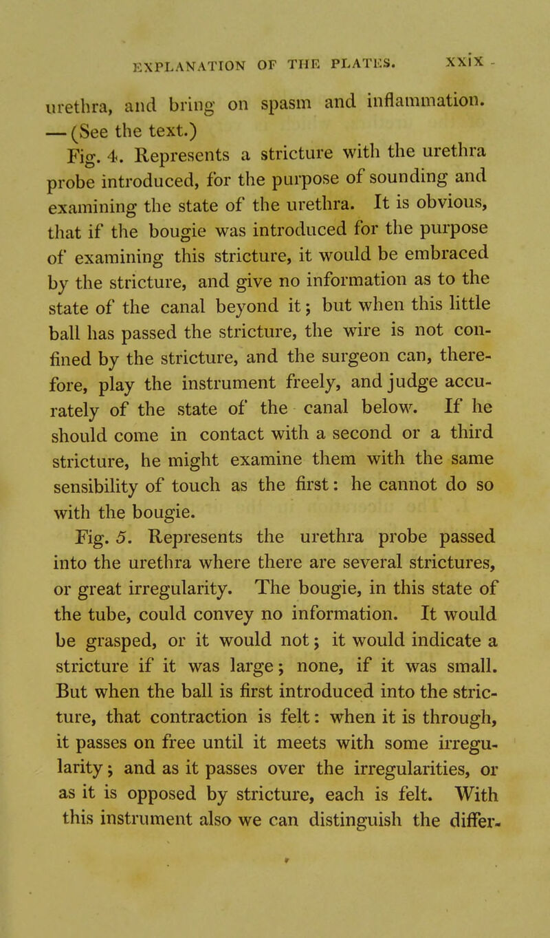 urethra, and bring on spasm and inflammation. — (See the text.) Fig. 4. Represents a stricture with the urethra probe introduced, for the purpose of sounding and examining the state of the urethra. It is obvious, that if the bougie was introduced for the purpose of examining this stricture, it would be embraced by the stricture, and give no information as to the state of the canal beyond it; but when this little ball has passed the stricture, the wire is not con- fined by the stricture, and the surgeon can, there- fore, play the instrument freely, and judge accu- rately of the state of the canal below. If he should come in contact with a second or a third stricture, he might examine them with the same sensibility of touch as the first: he cannot do so with the bougie. Fig. 5. Represents the urethra probe passed into the urethra where there are several strictures, or great irregularity. The bougie, in this state of the tube, could convey no information. It would be grasped, or it would not j it would indicate a stricture if it was large; none, if it was small. But when the ball is first introduced into the stric- ture, that contraction is felt: when it is through, it passes on free until it meets with some irregu- larity ; and as it passes over the irregularities, or as it is opposed by stricture, each is felt. With this instrument also we can distinguish the differ-