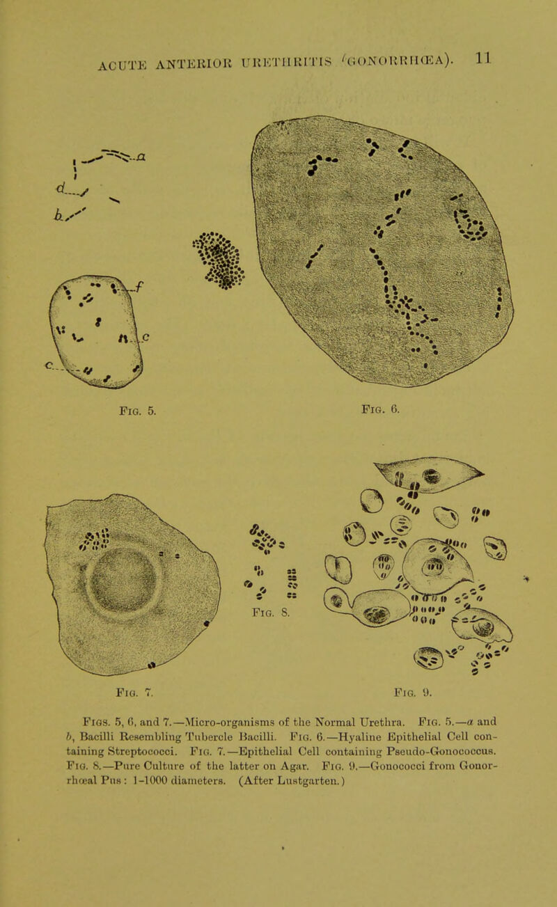 Via. 7. Fig. '.). Figs. 5, 0, and 7.—Micro-organisms of the Normal Urethra. Fig. 5,—a and b, Bacilli Resembling Tubercle Bacilli. Fig. 6.—Hyaline Epithelial Cell con- taining Streptococci. Fig. 7.—Epithelial Cell containing Pseudo-Gonococcus. Fig. 8.—Pure Culture of the latter on Agar. Fig. 1).—Gonococci from Gonor- rhoea! Pus : 1-1000 diameters. (After Lustgarten.)