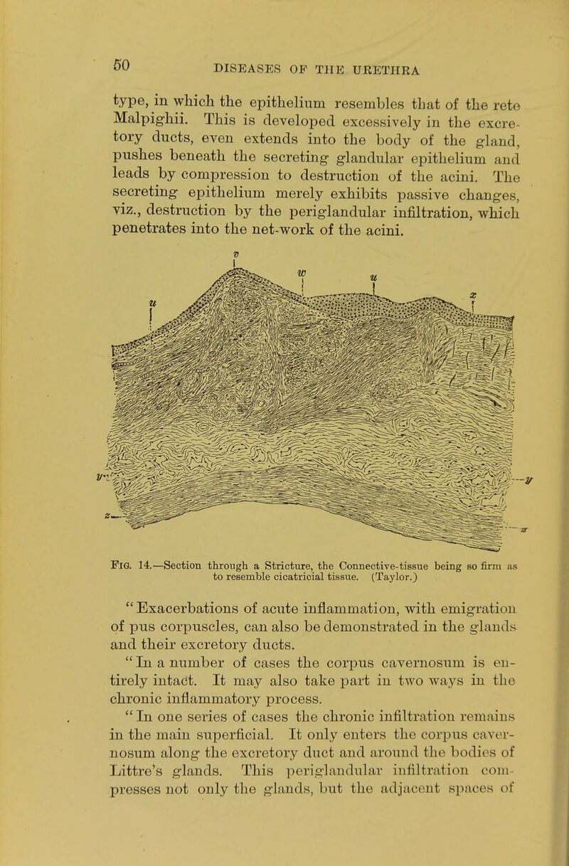 type, in which the epithelium resembles that of the rete Malpighii. This is developed excessively in the excre- tory ducts, even extends into the body of the gland, pushes beneath the secreting glandular epithelium and leads by compression to destruction of the acini. The secreting epithelium merely exhibits passive changes, viz., destruction by the periglandular infiltration, which penetrates into the net-work of the acini. v i PlG. 14.—Section through a Stricture, the Connective-tissue being so firm as to resemble cicatricial tissue. (Taylor.)  Exacerbations of acute inflammation, with emigration of pus corpuscles, can also be demonstrated in the glands and their excretory ducts. In a number of cases the corpus cavernosum is en- tirely intact. It may also take part in two ways in the chronic inflammatory process. In one series of cases the chronic infiltration remains in the main superficial. It only enters the corpus caver- nosum along the excretory duct and around the bodies of Littre's glands. This periglandular infiltration com- presses not only the glands, but the adjacent spaces of