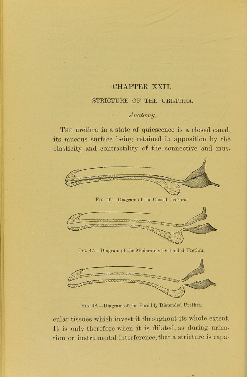 CHAPTER XXII. STEICTUEE OP THE UEETHEA. Anatomy. The urethra in a state of quiescence is a closed canal, its mucous surface being retained in apposition by the elasticity and contractility of the connective and mus- Fig. 46.—Diagram of the Closed Urethra. Fig. 47.—Diagram of the Moderately Distended Urethra. Fig. 48.—Diagram of the Forcibly Distended Urethra. cular tissues which invest it throughout its whole extent. It is only therefore when it is dilated, as during urina- tion or instrumental interference, that a stricture is capa-